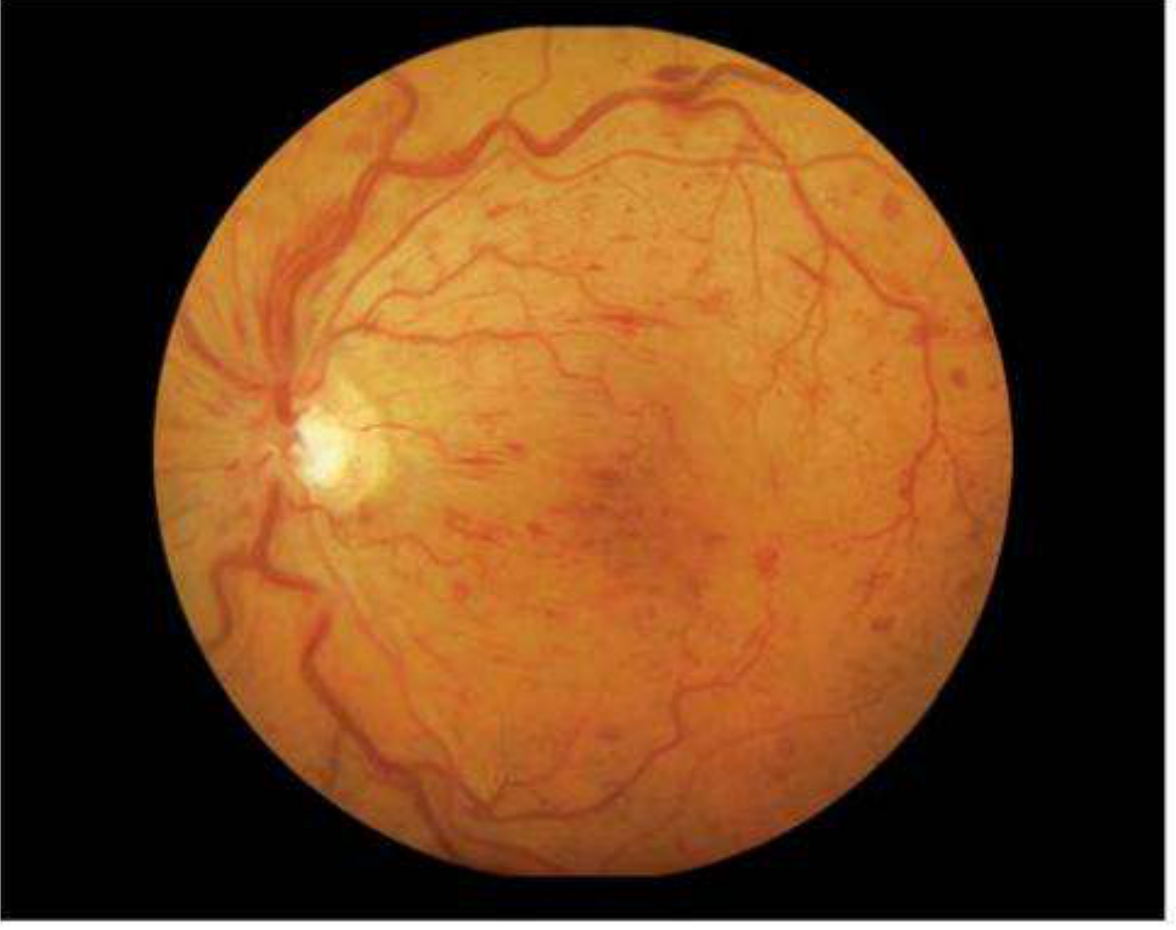 Normal fundus — direct ophthalmoscopy view