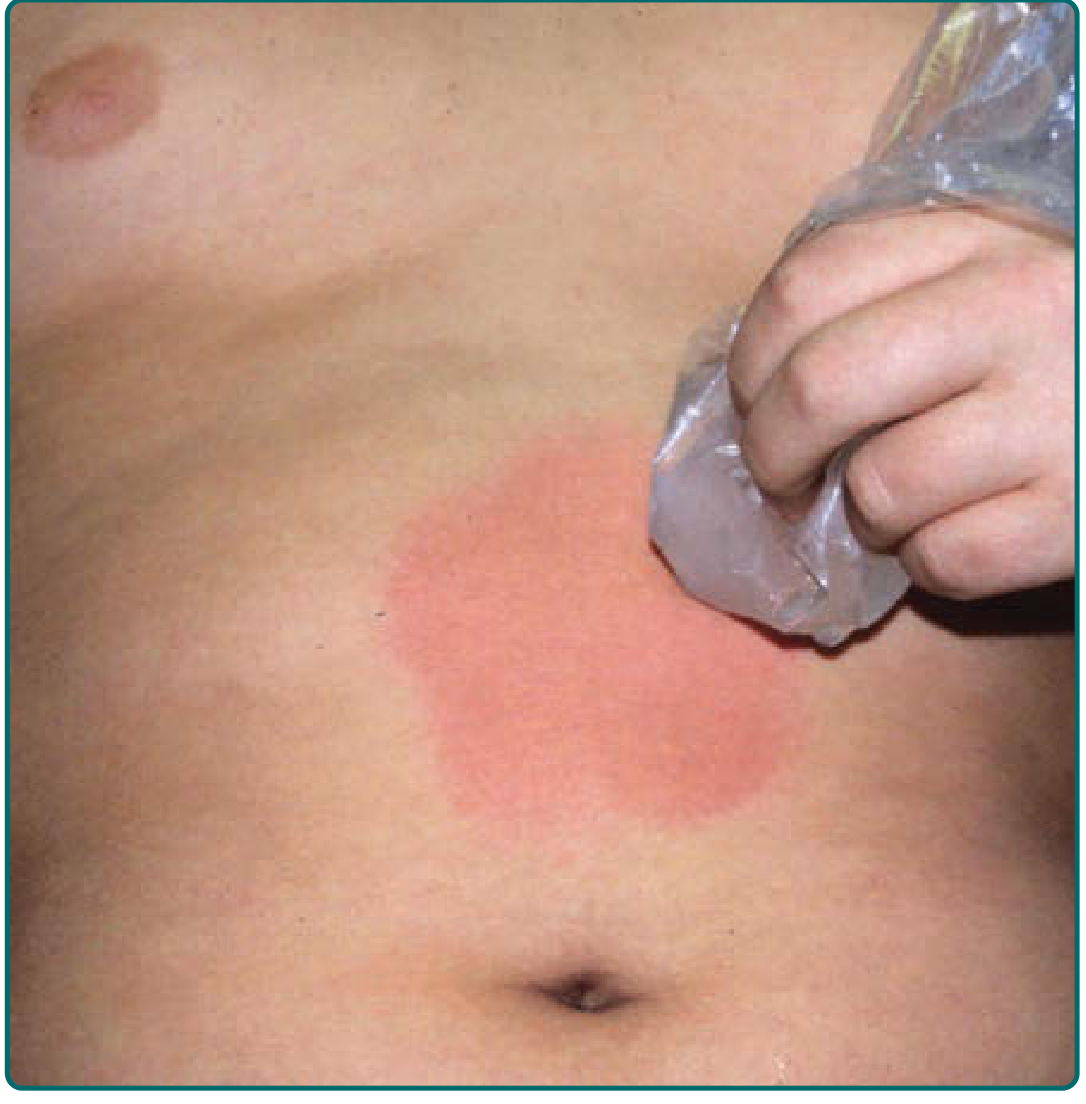 Cold urticaria - ice cube provocation test showing a circular erythematous wheal on the torso