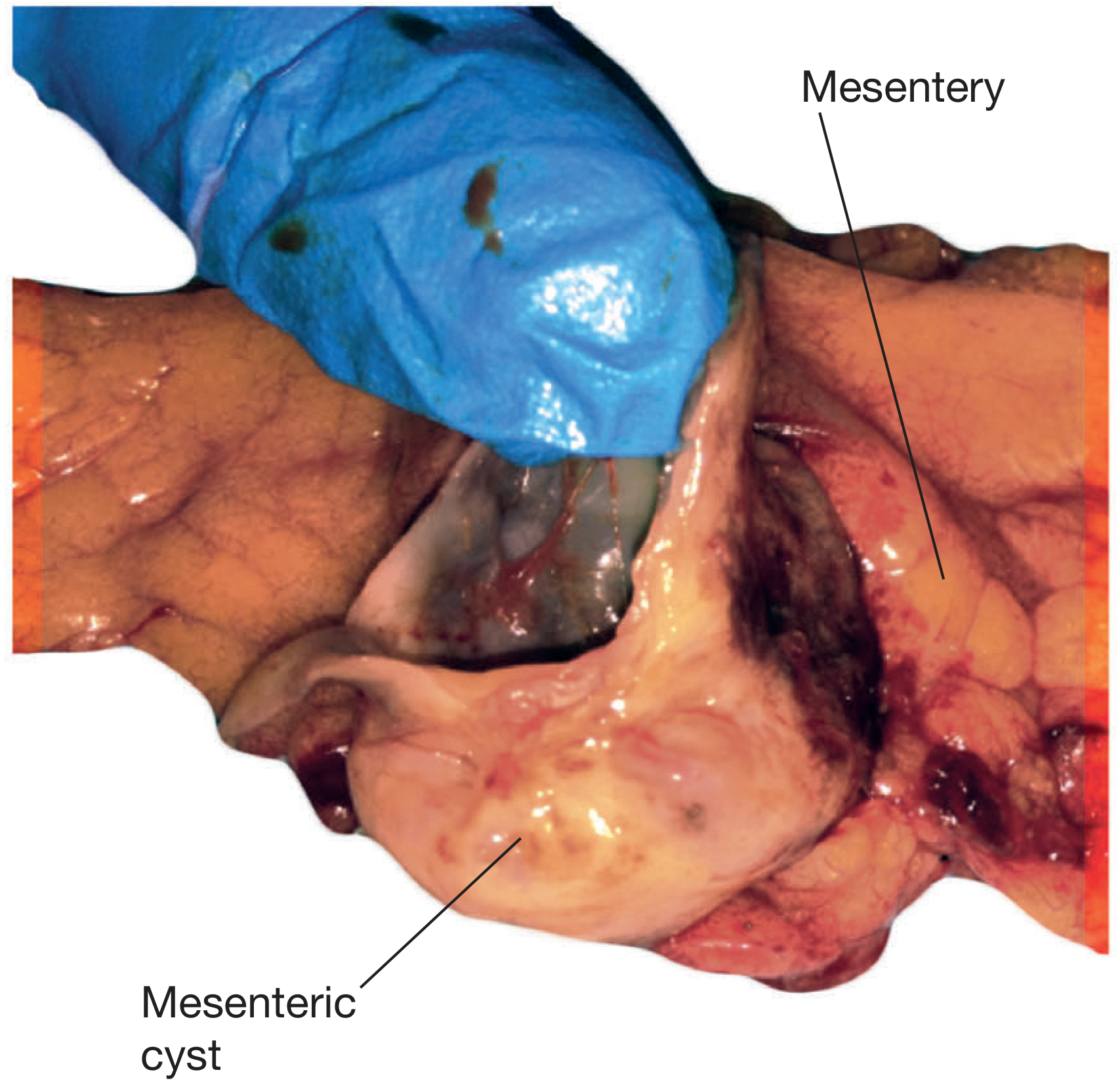 Surgical view of mesenteric cyst