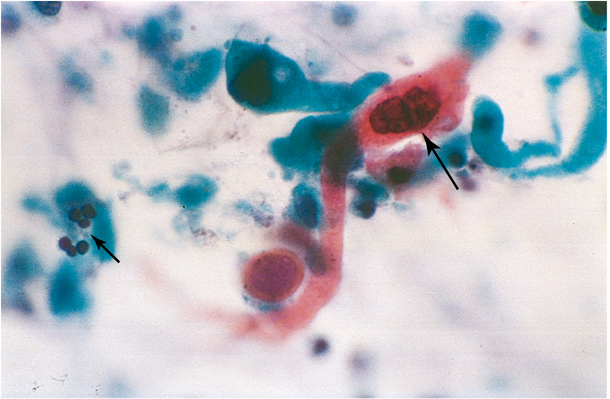 Sputum cytology - SCC
