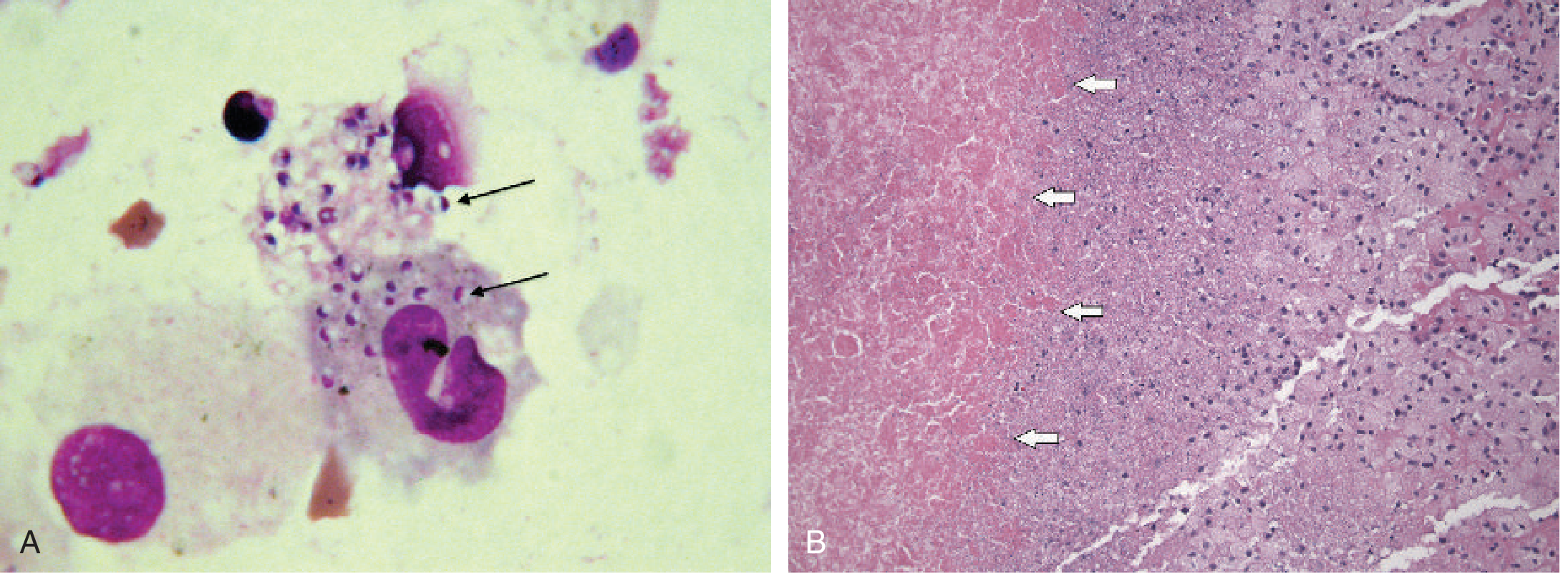 Histoplasma capsulatum in adrenal biopsy - (A) BAL intracellular yeast cells with Giemsa stain, (B) Adrenal gland biopsy H&E showing necrotic area (arrows) with remaining adrenal tissue; GMS stain reveals yeast-filled necrosis