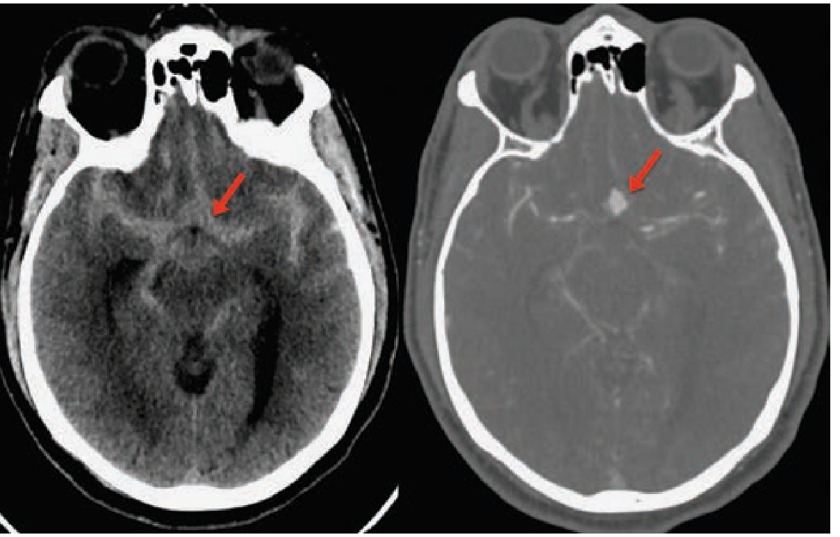 Non-contrast CT showing diffuse subarachnoid blood in the cisterns with CTA confirming anterior communicating artery aneurysm