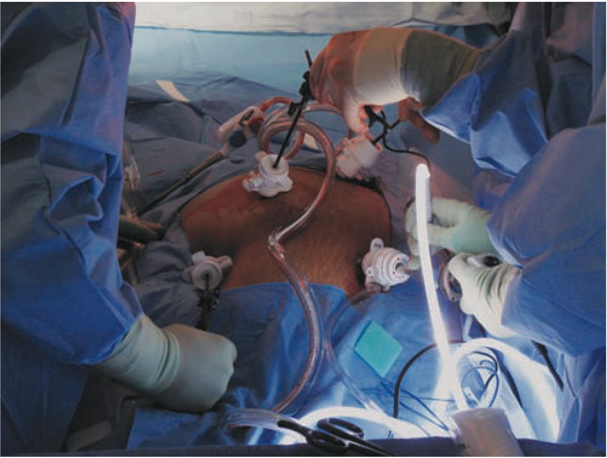 Intraoperative photo showing four trocars placed on the patient's abdomen during laparoscopic cholecystectomy - Maingot's