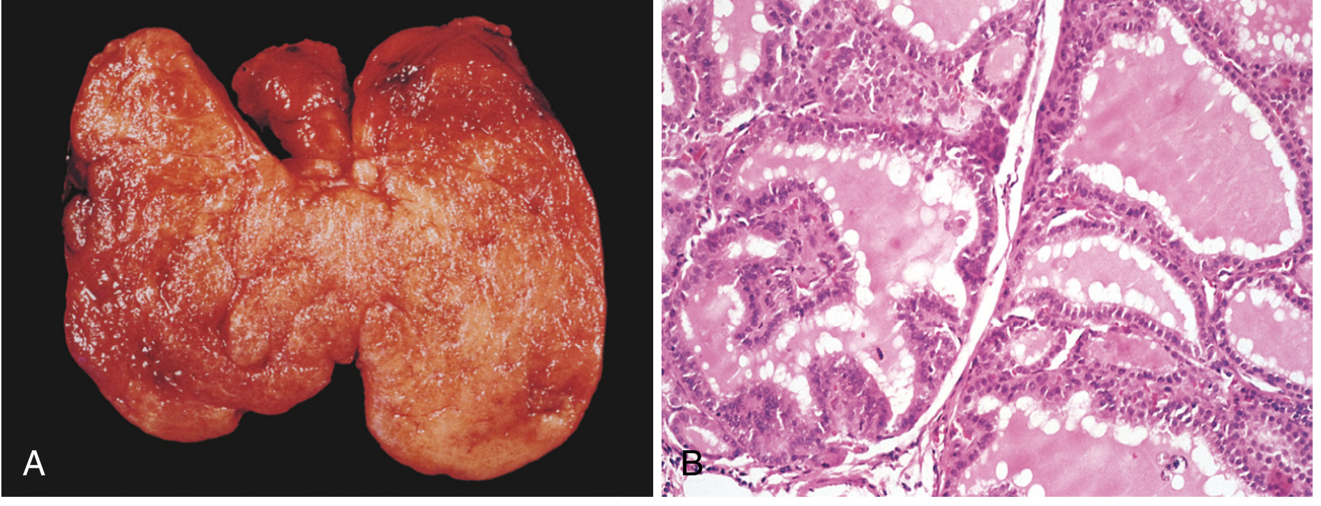 Graves disease - (A) Diffuse symmetric thyroid enlargement with beefy red parenchyma. (B) Histology showing tall columnar epithelium with crowded cells forming papillary projections into follicle lumens, with scalloped colloid margins.