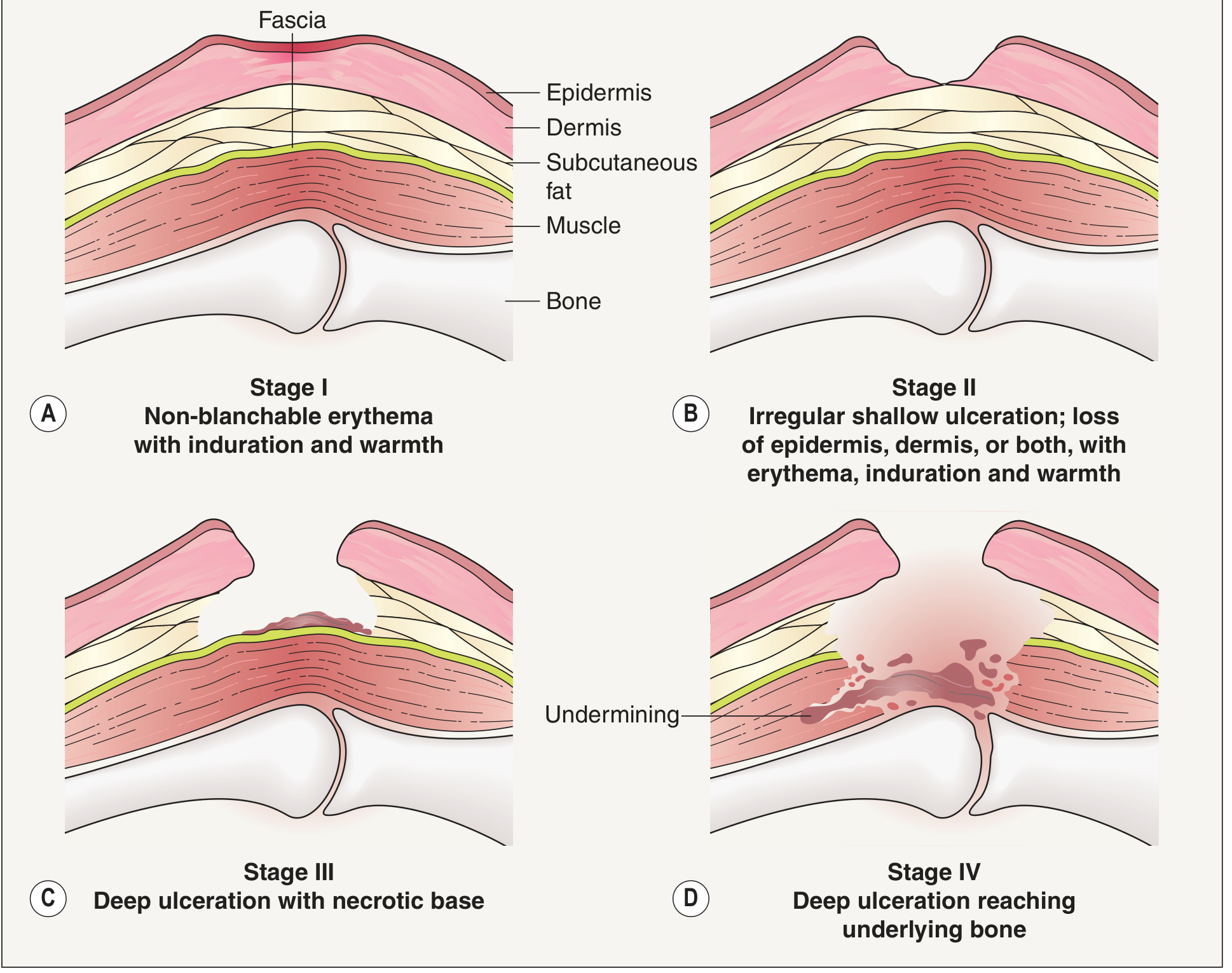 Pressure ulcer staging diagram showing all four stages from non-blanchable erythema to deep ulceration reaching bone