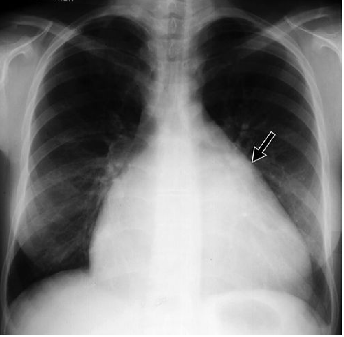 LAA enlargement in mitral regurgitation - Grainger & Allison's Diagnostic Radiology