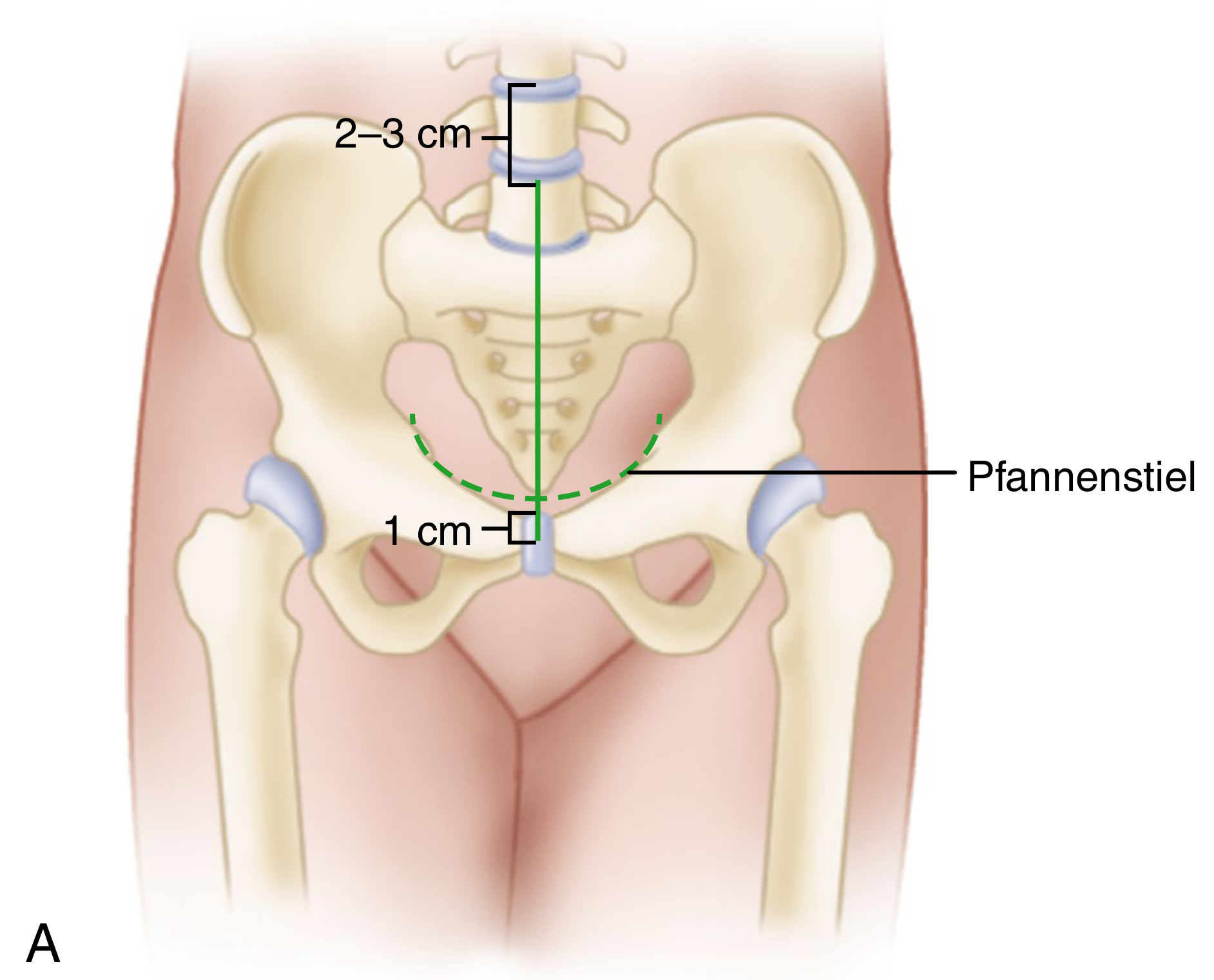 Stoppa approach incision - Pfannenstiel (dashed) and optional vertical midline (solid green line), ~2-3 cm below umbilicus down to 1 cm above symphysis