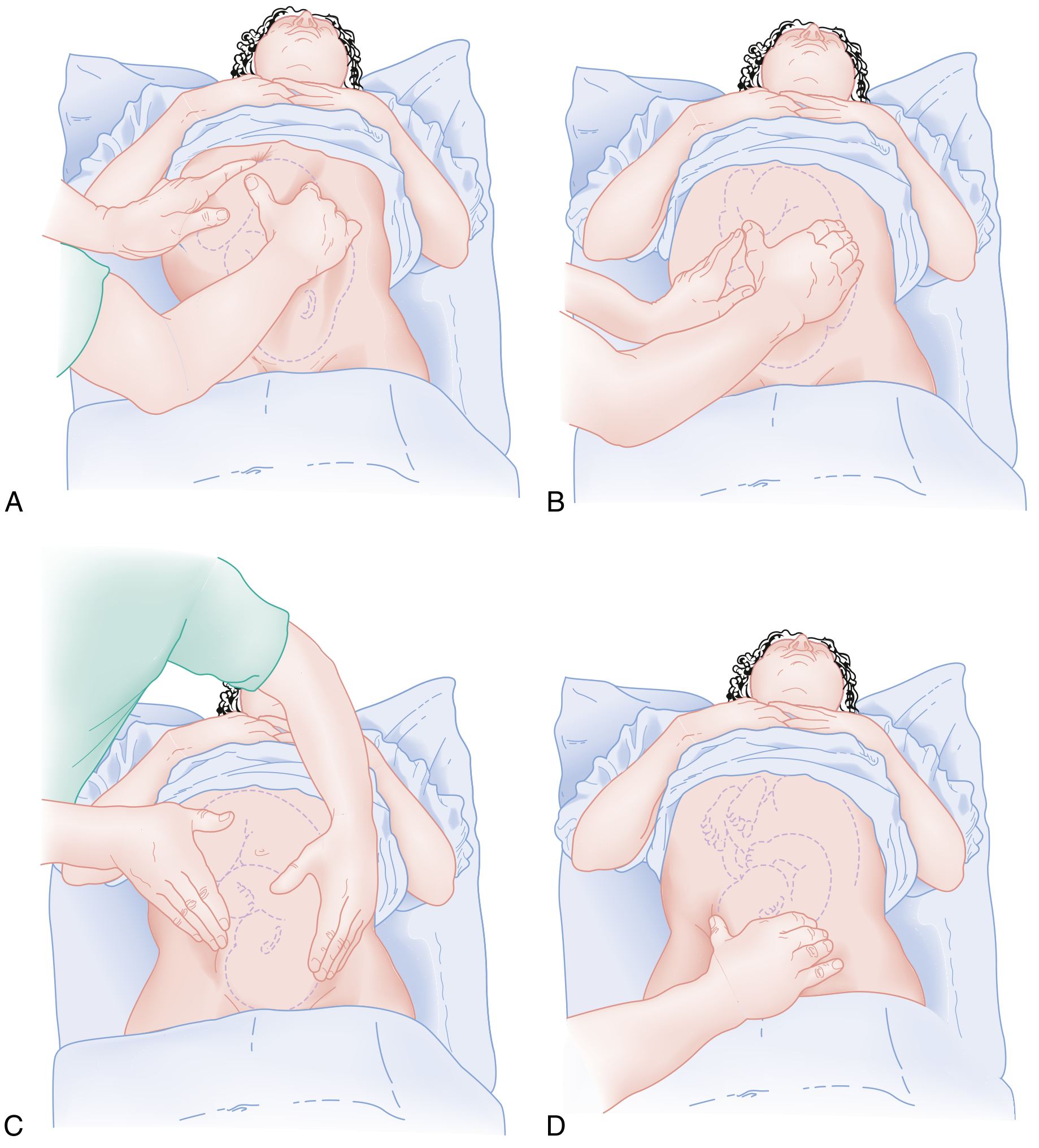 Leopold's Maneuvers β Four Steps (Rosen's Emergency Medicine)