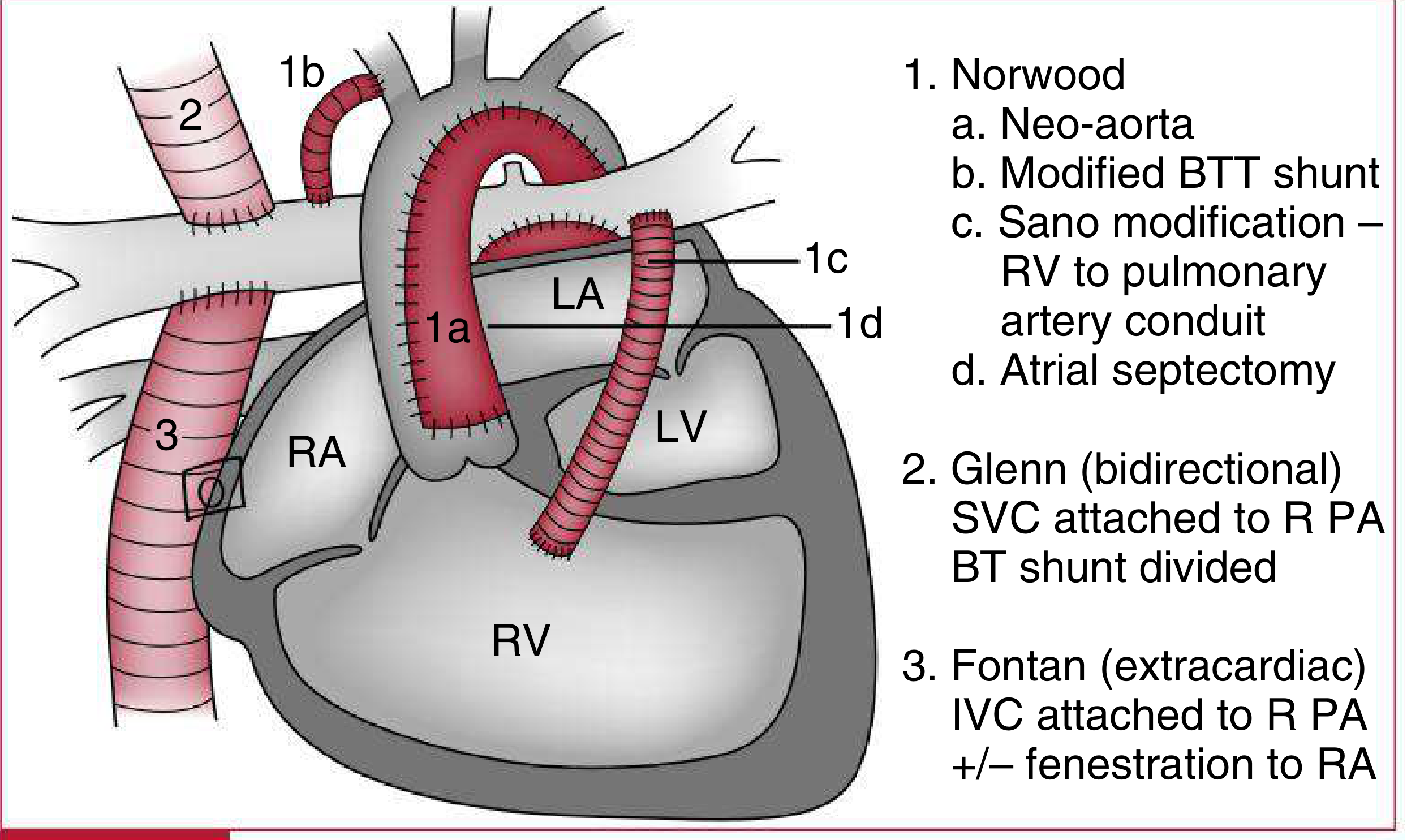 Schematic of cardiac shunts showing Norwood, Glenn, and Fontan stages