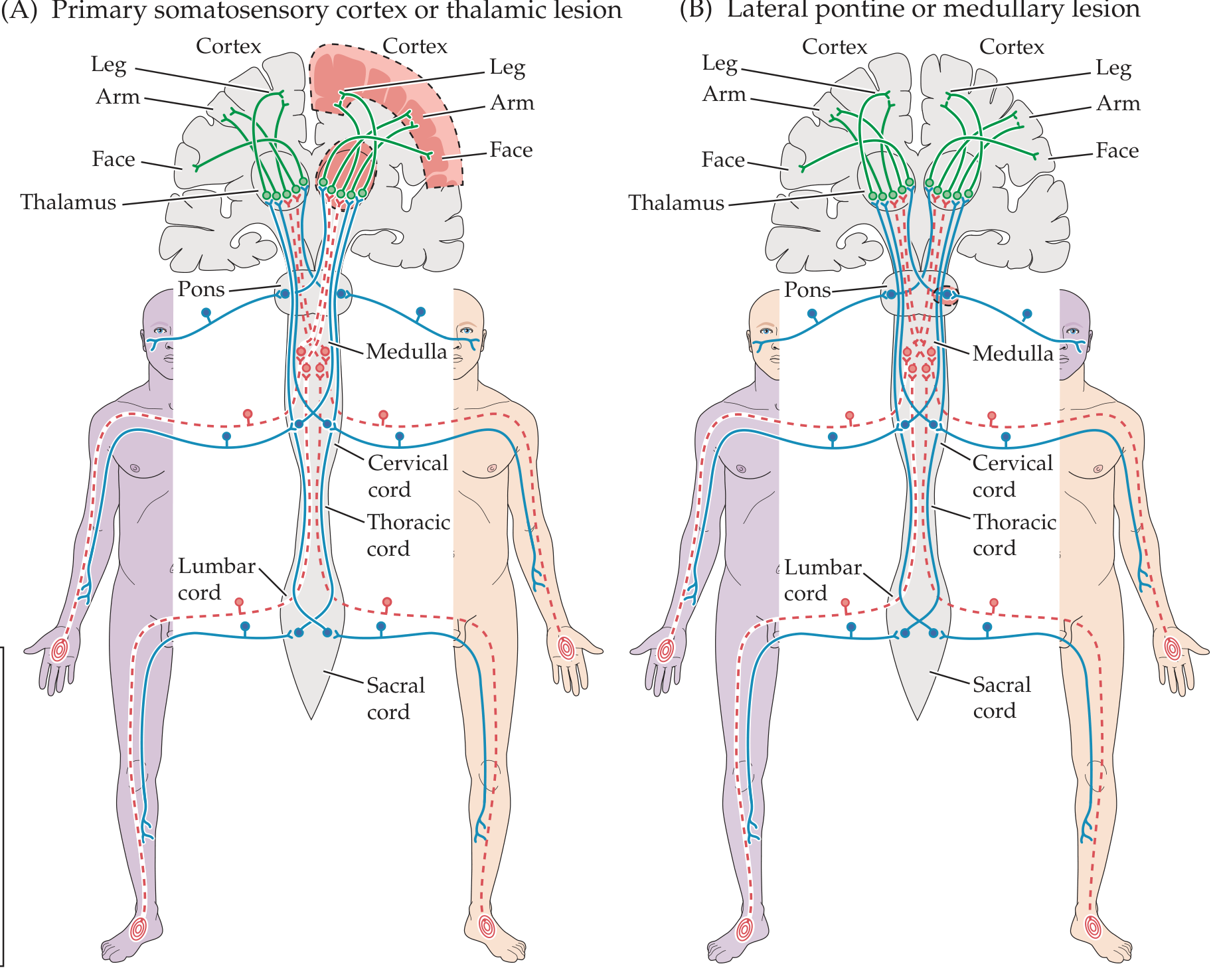 Patterns of sensory loss by lesion level (primary somatosensory cortex/thalamic vs. lateral pontine/medullary)