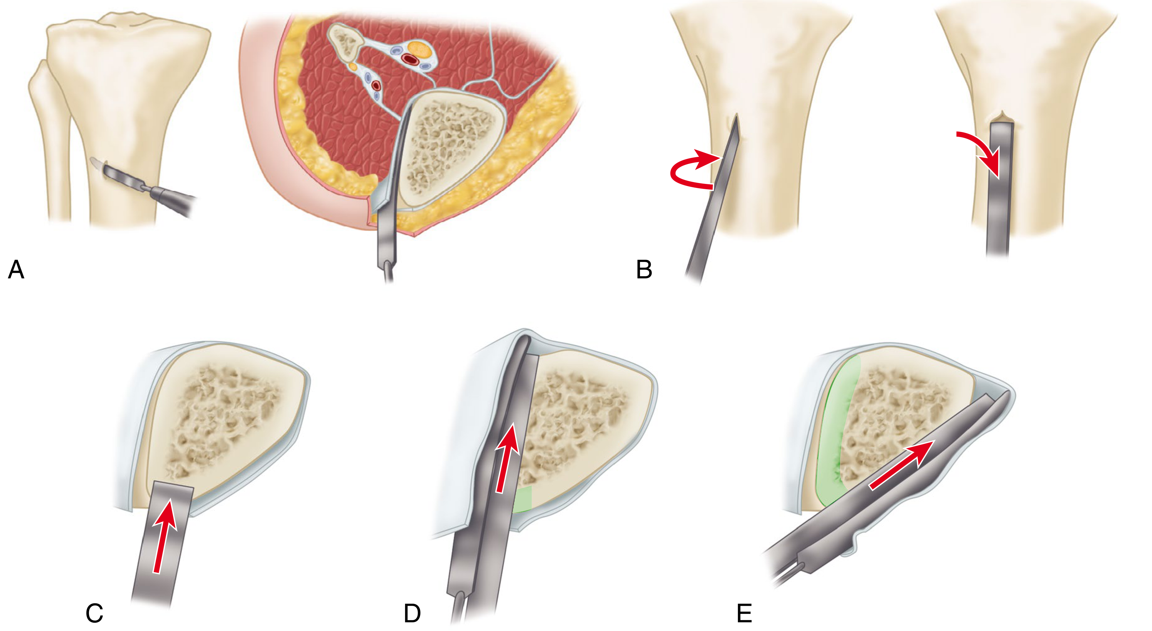 Corticotomy using osteotome - Paley technique showing sequential cortex cutting steps