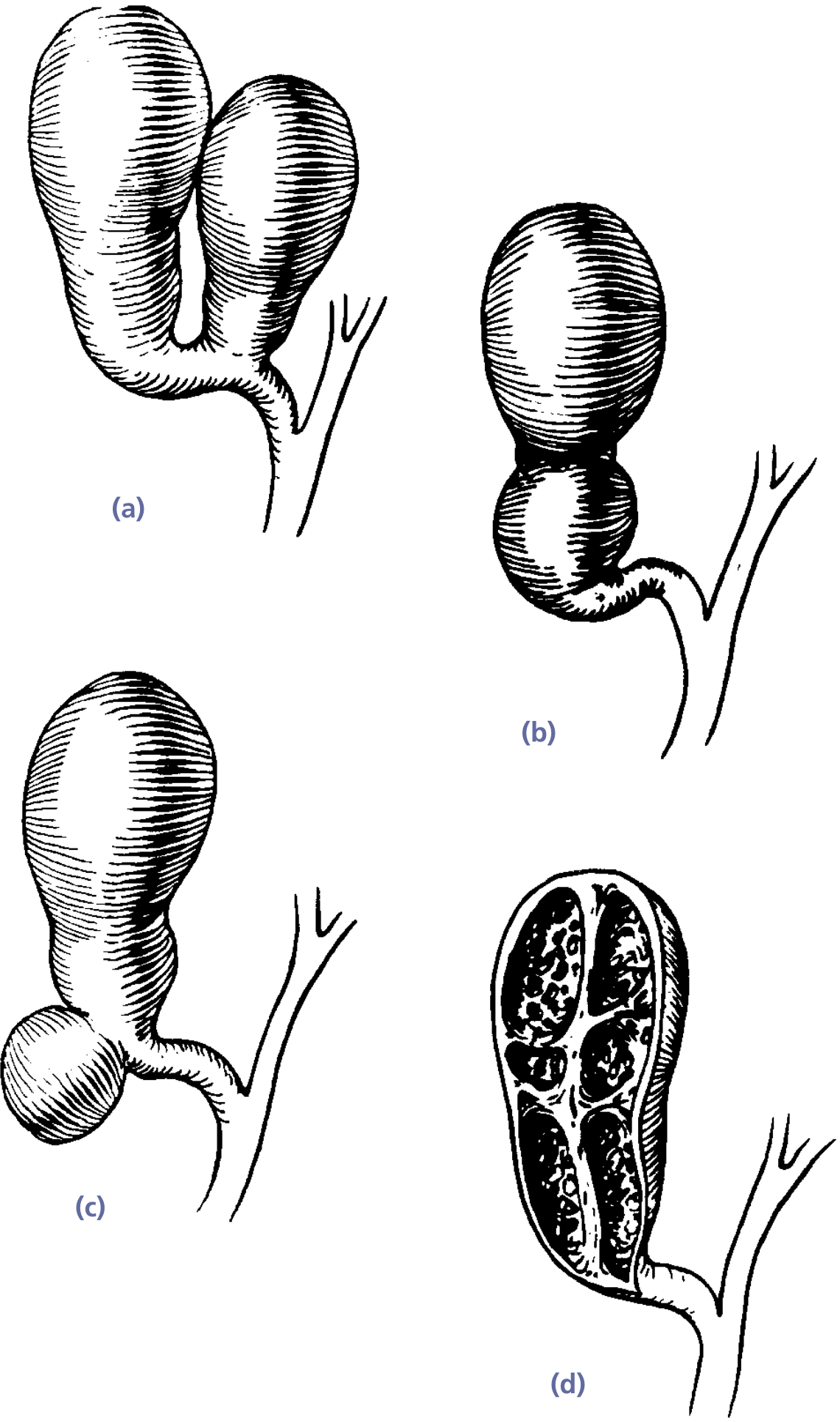 Gallbladder congenital anomalies: double gallbladder (a), bilobed gallbladder (b), diverticulum at neck (c), and septated gallbladder (d)