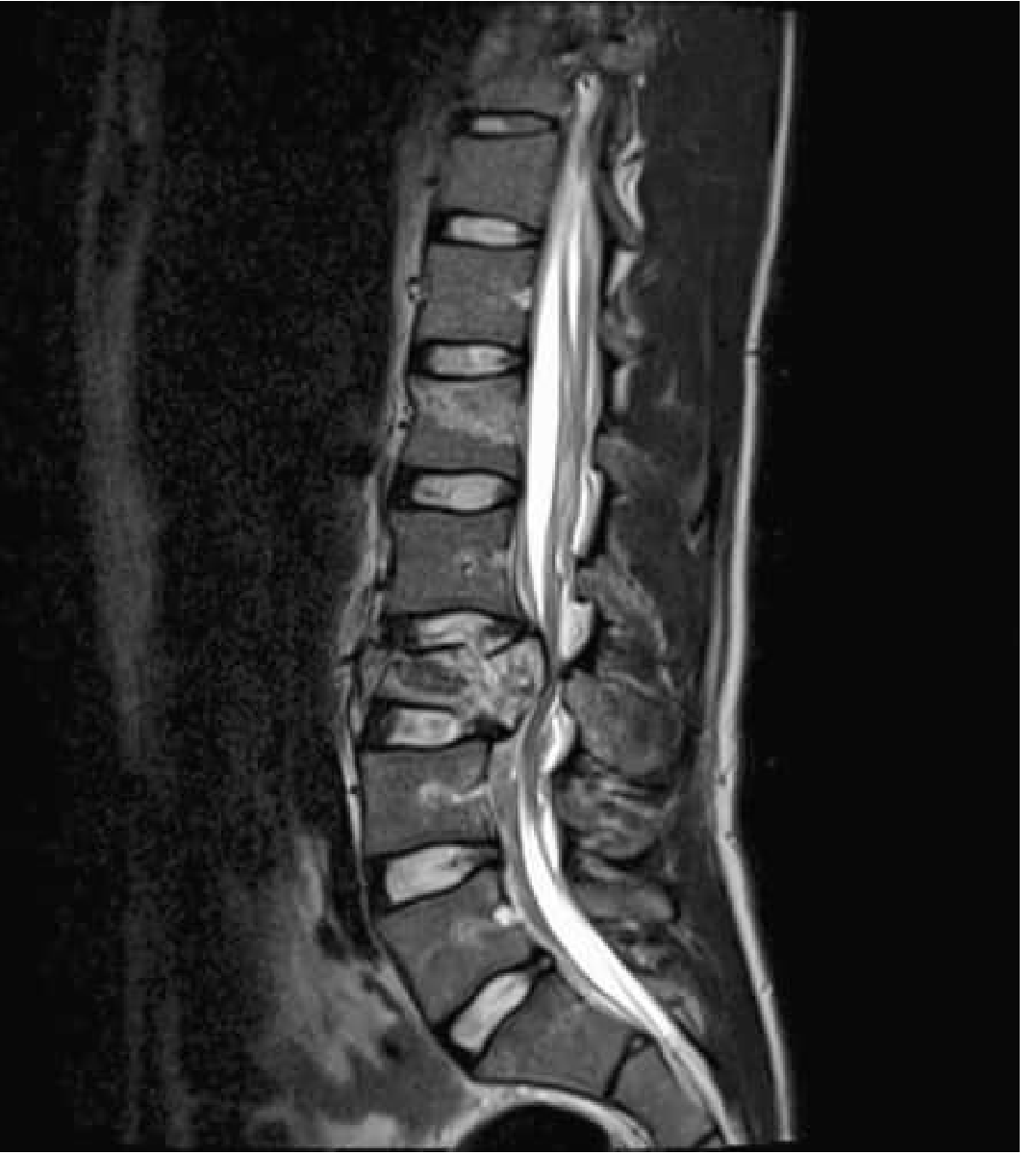 Cauda Equina Syndrome — T2 sagittal MRI showing L3 burst fracture