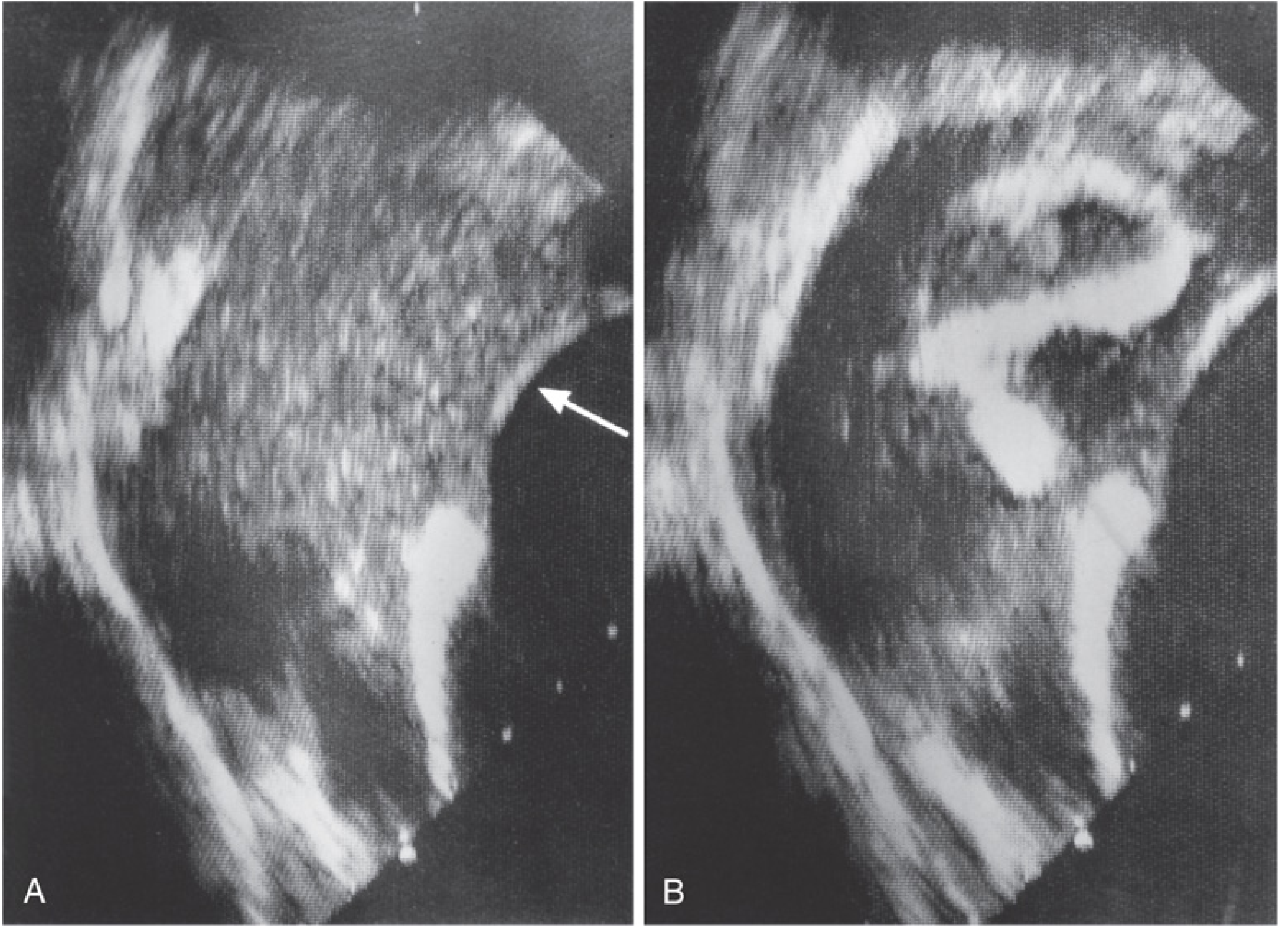 Intraoperative TEE showing emboli in the right atrium during cemented hip arthroplasty - (A) multiple small emboli (arrow), (B) large embolus ~7 cm, likely a cast of the femoral vein