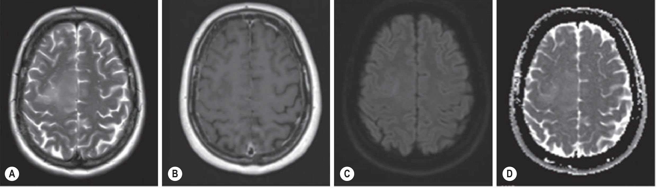 IDH-wt astrocytoma MRI: T2, post-Gd T1, DWI, ADC - Grainger & Allison's