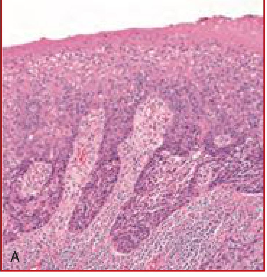 Carcinoma in situ histology - Cummings Otolaryngology