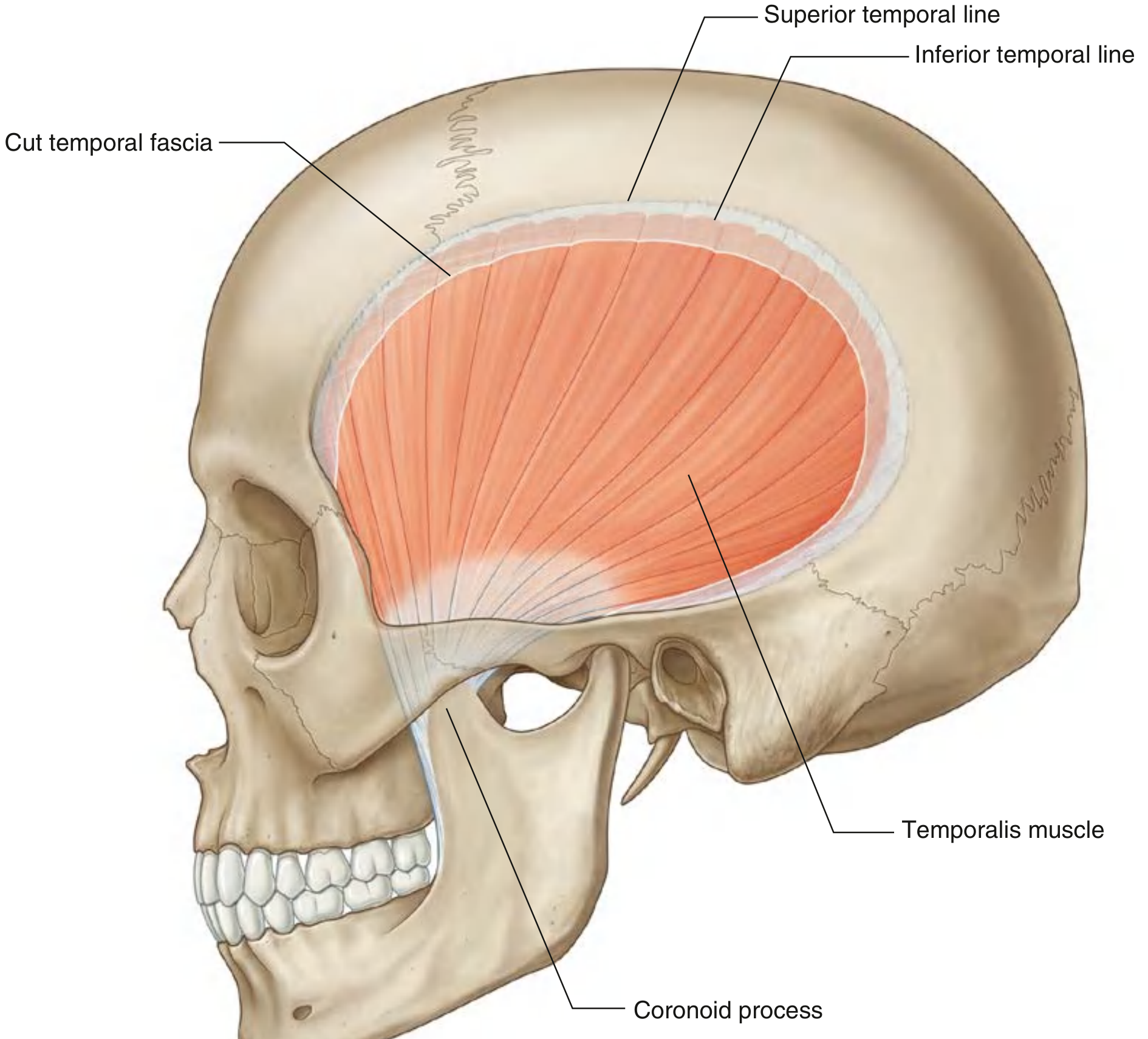 Temporalis muscle - lateral view showing superior and inferior temporal lines, cut temporal fascia, temporalis muscle belly, and insertion on coronoid process