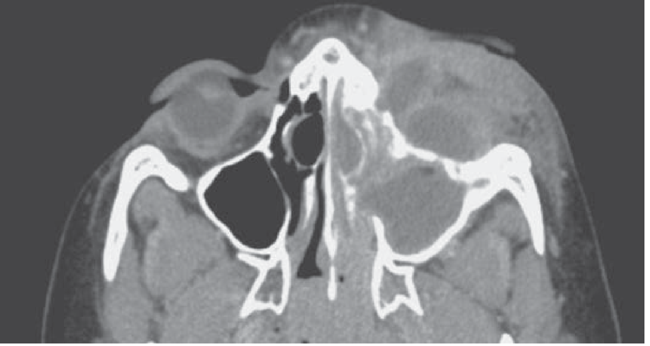 Orbital cellulitis subperiosteal abscess CT axial