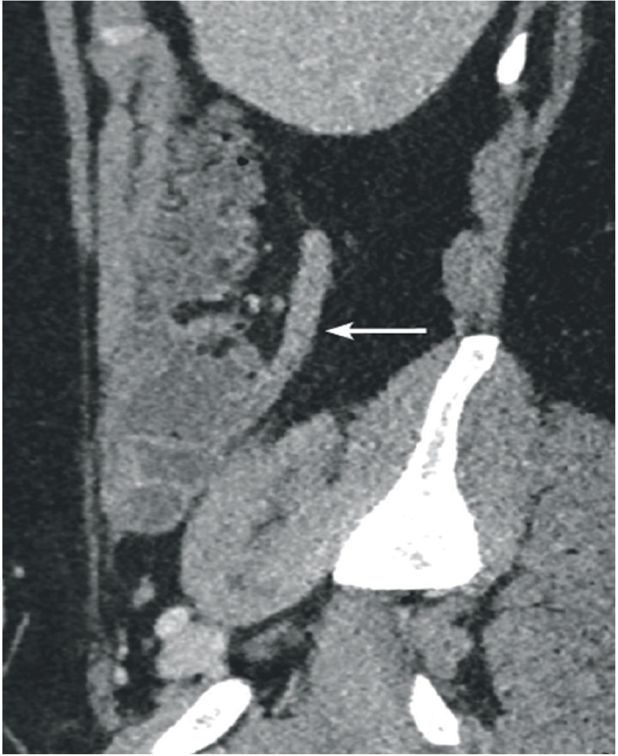 CT scan showing enlarged appendix with periappendiceal fat stranding - arrow indicating the appendix