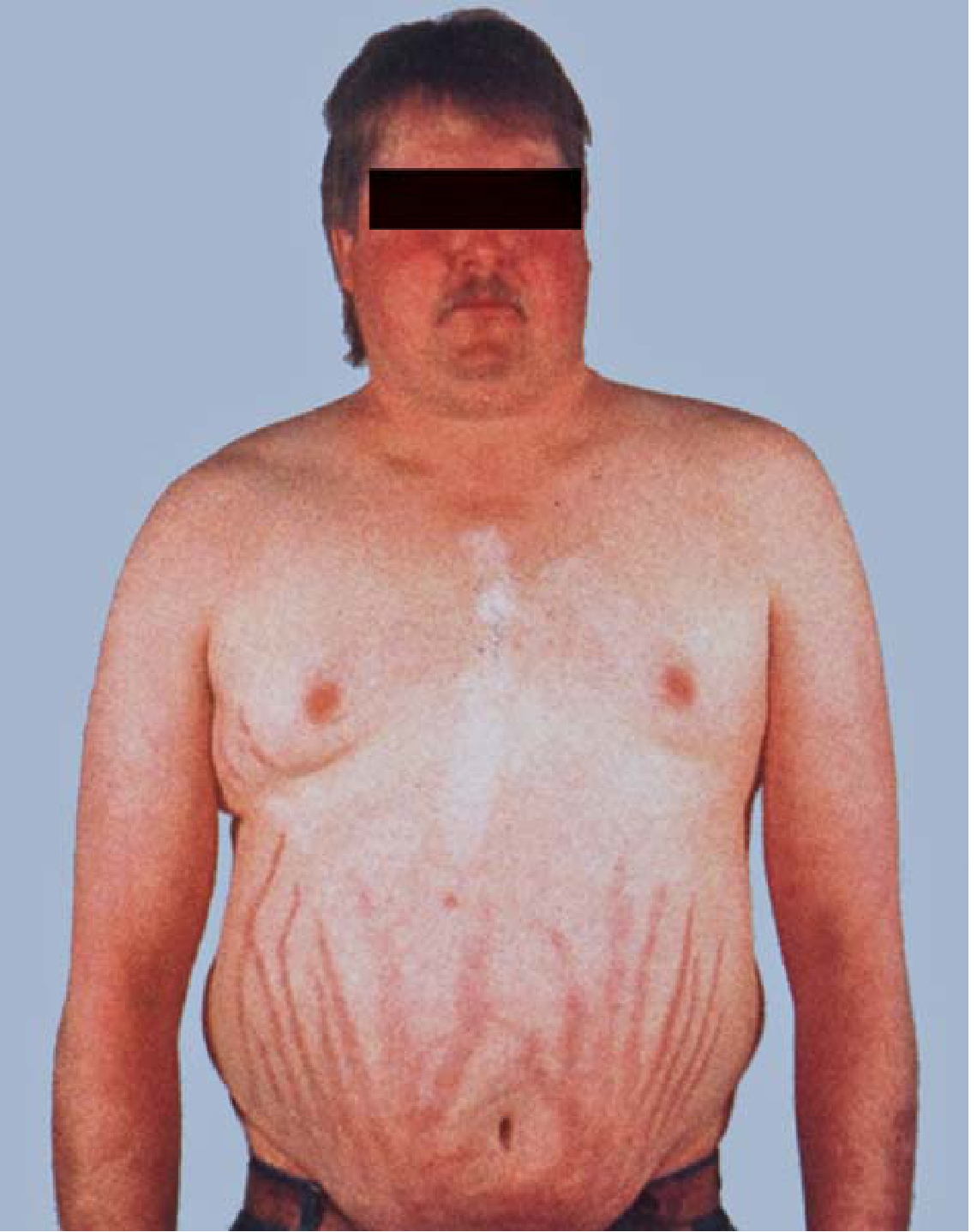 Cushing syndrome patient showing central obesity, moon facies, and abdominal striae