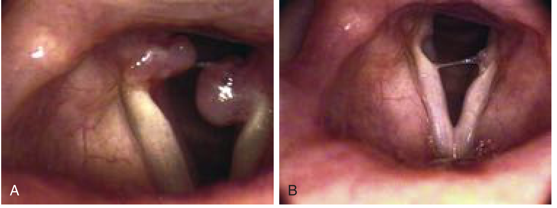 Intubation granulomas post-endotracheal tube - bilateral, from Cummings Otolaryngology