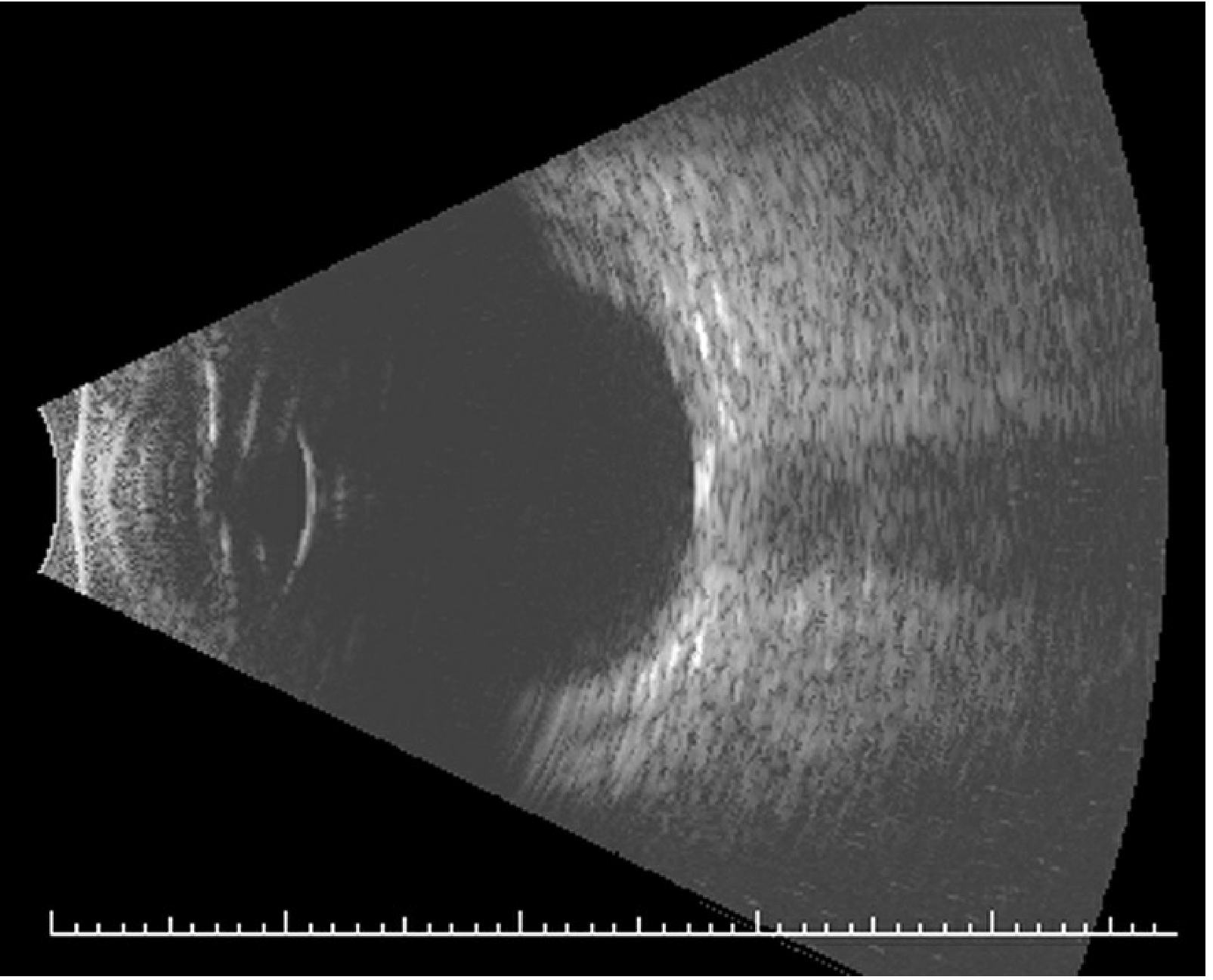 Normal B-scan ultrasonography of the eye