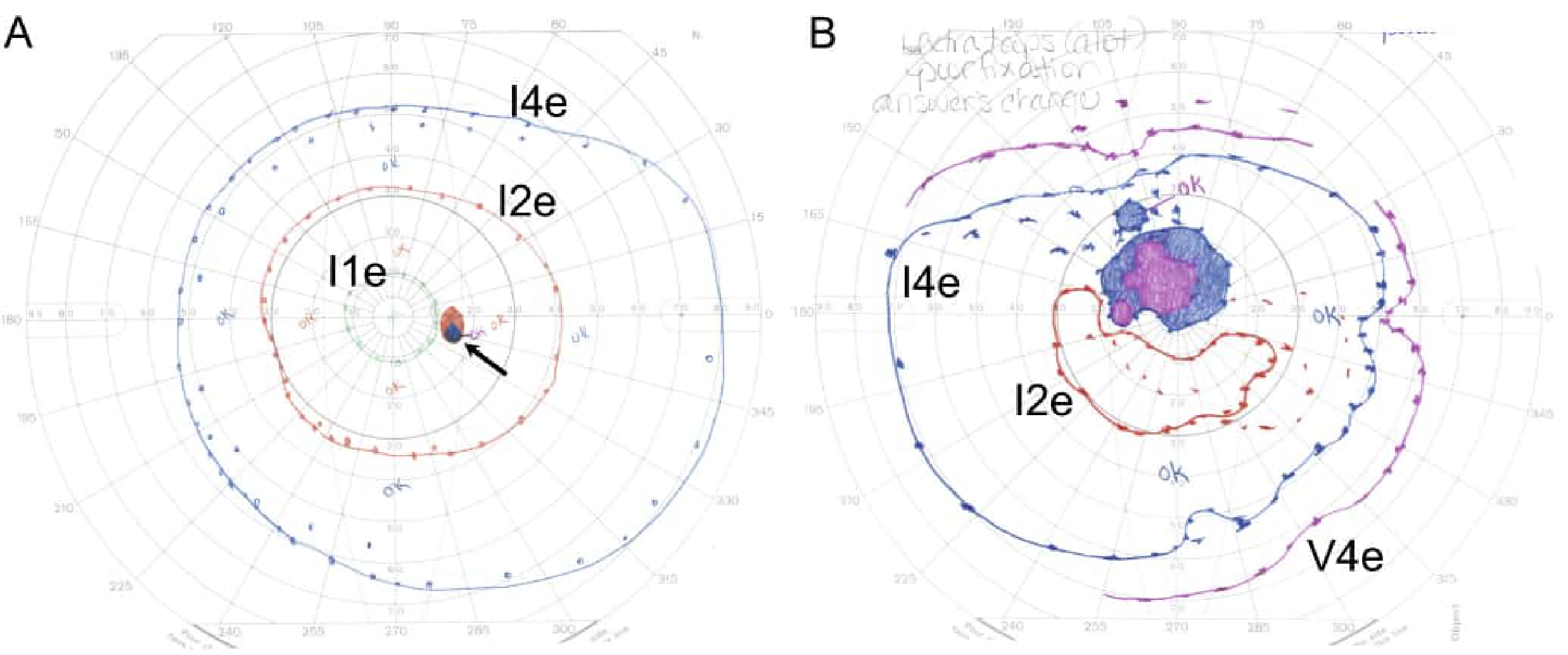 Goldmann Visual Fields - Normal (A) and Leber Hereditary Optic Neuropathy showing cecocentral scotoma (B)