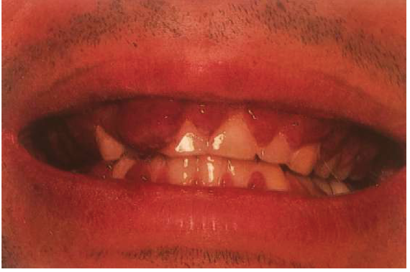 Linear gingival erythema HIV - bright red band along gingival margin with missing teeth