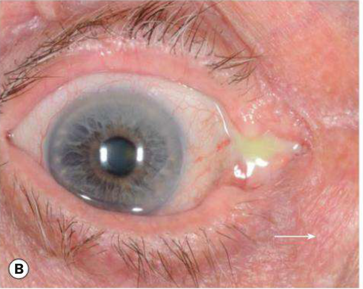 Mucopurulent discharge being expressed from punctum - chronic dacryocystitis