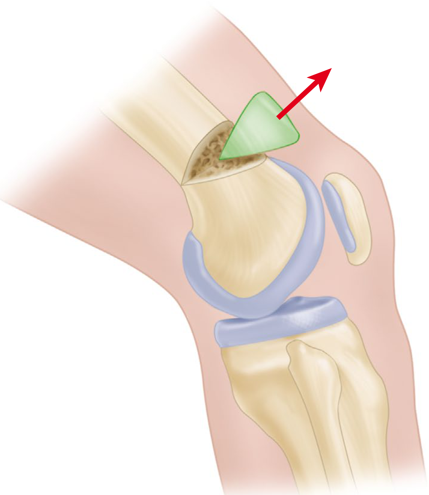 Supracondylar extension osteotomy for flexion contracture of knee