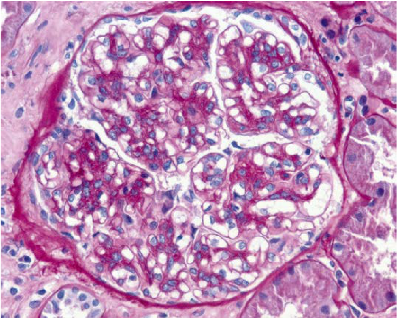 IgA nephropathy - PAS showing mesangial hypercellularity and matrix increase