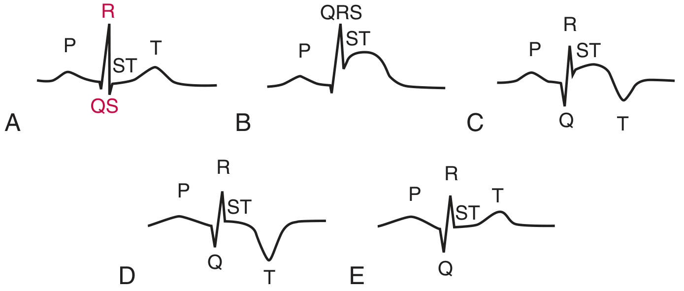 Serial ECG changes in acute MI: A=normal, B=ST elevation, C=T wave inversion + Q wave, D=ST normalizing, E=T wave upright but Q persists