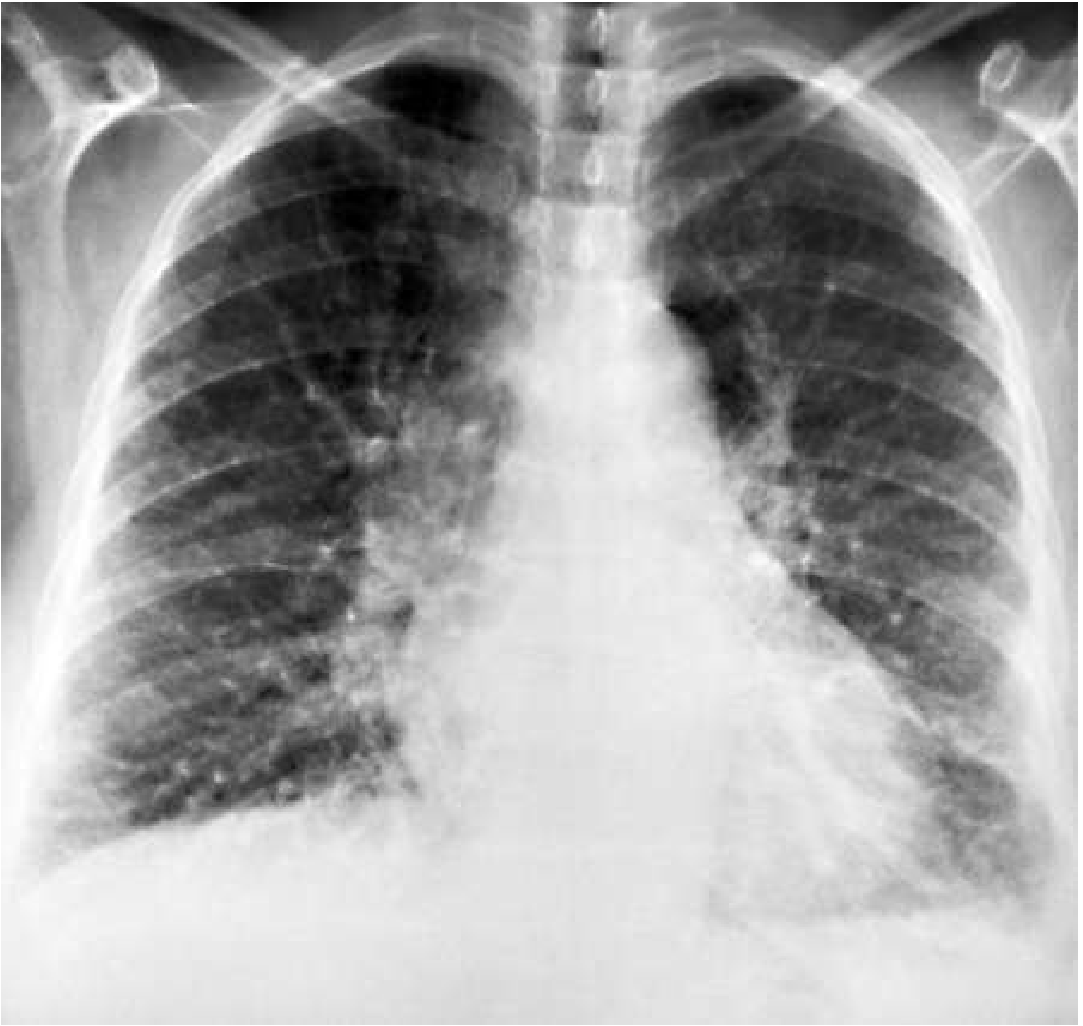 CXR showing cephalisation of pulmonary vessels in left ventricular failure