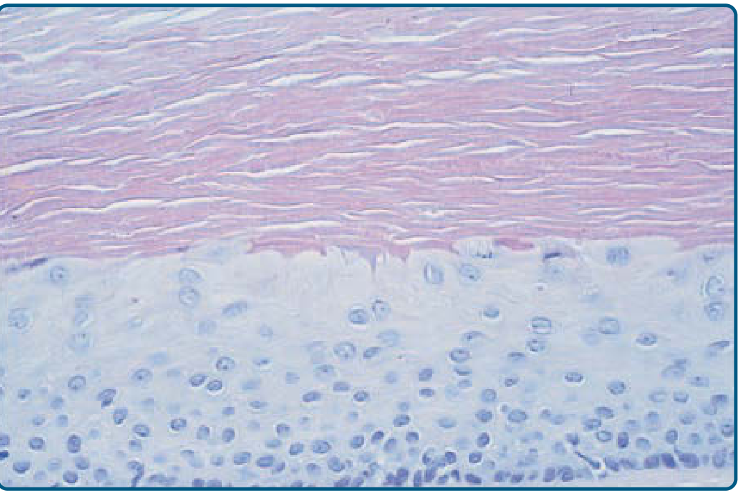 Trichilemmal cyst histology — abrupt keratinization without granular layer; eosinophilic compact keratin contents