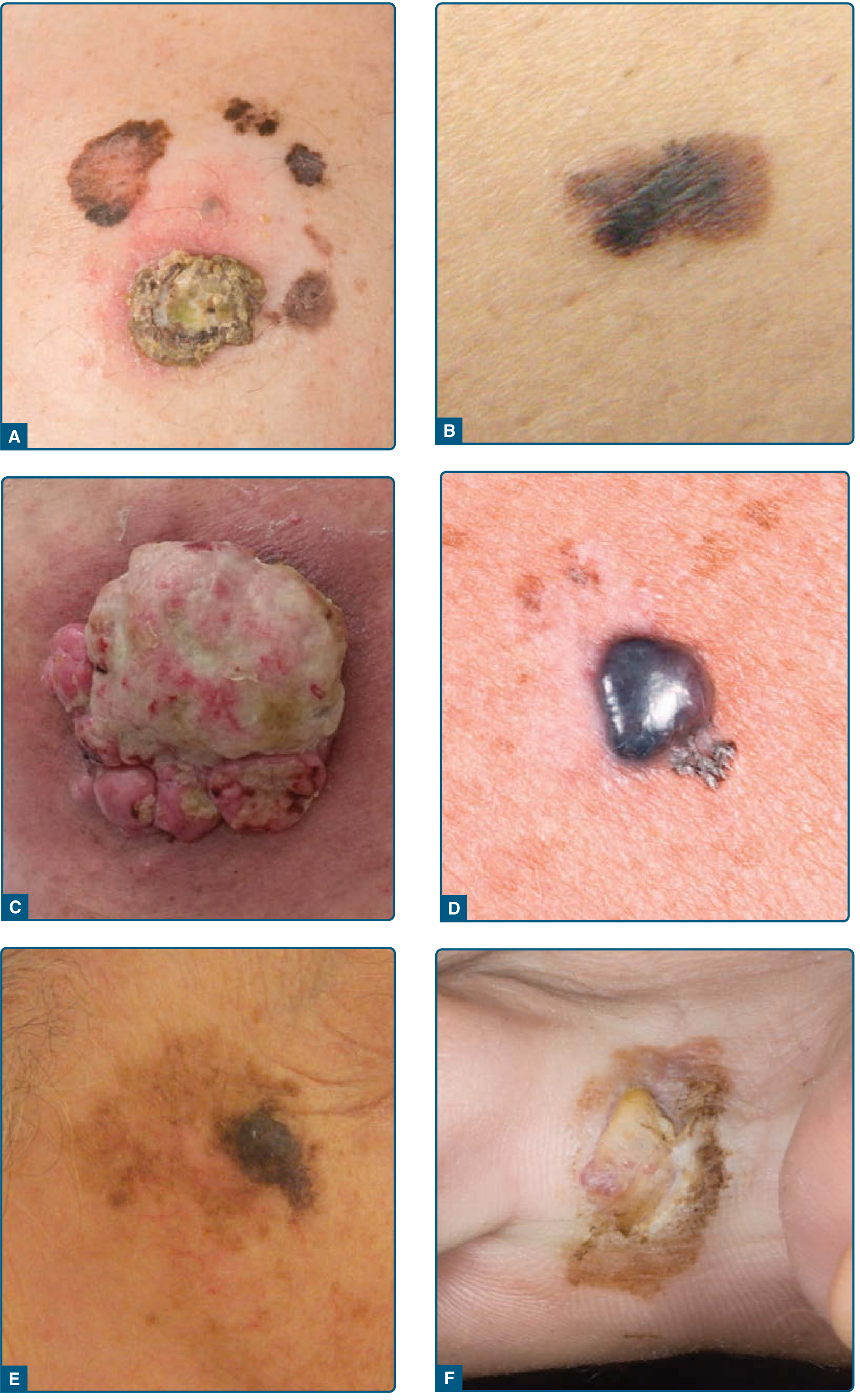 Fitzpatrick's Dermatology Fig 116-2 clinical subtypes
