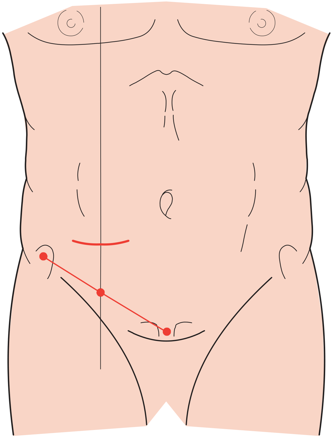 Lanz incision diagram showing transverse skin crease incision 2 cm below umbilicus, centred on the midclavicular-midinguinal line