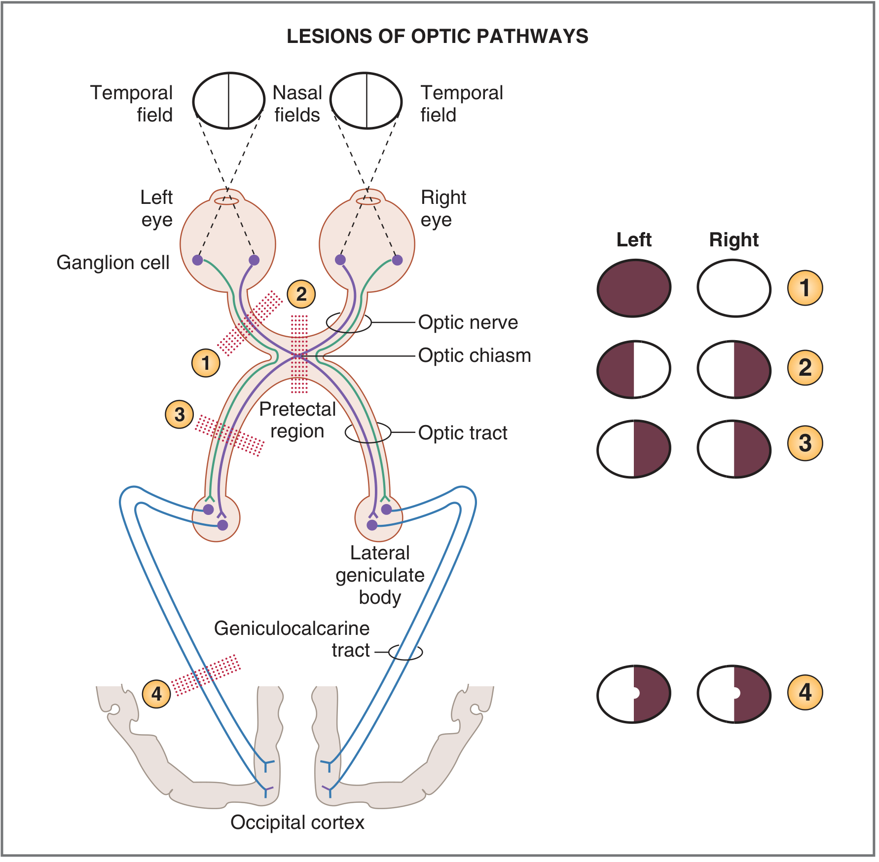 Visual pathway lesions and field defects