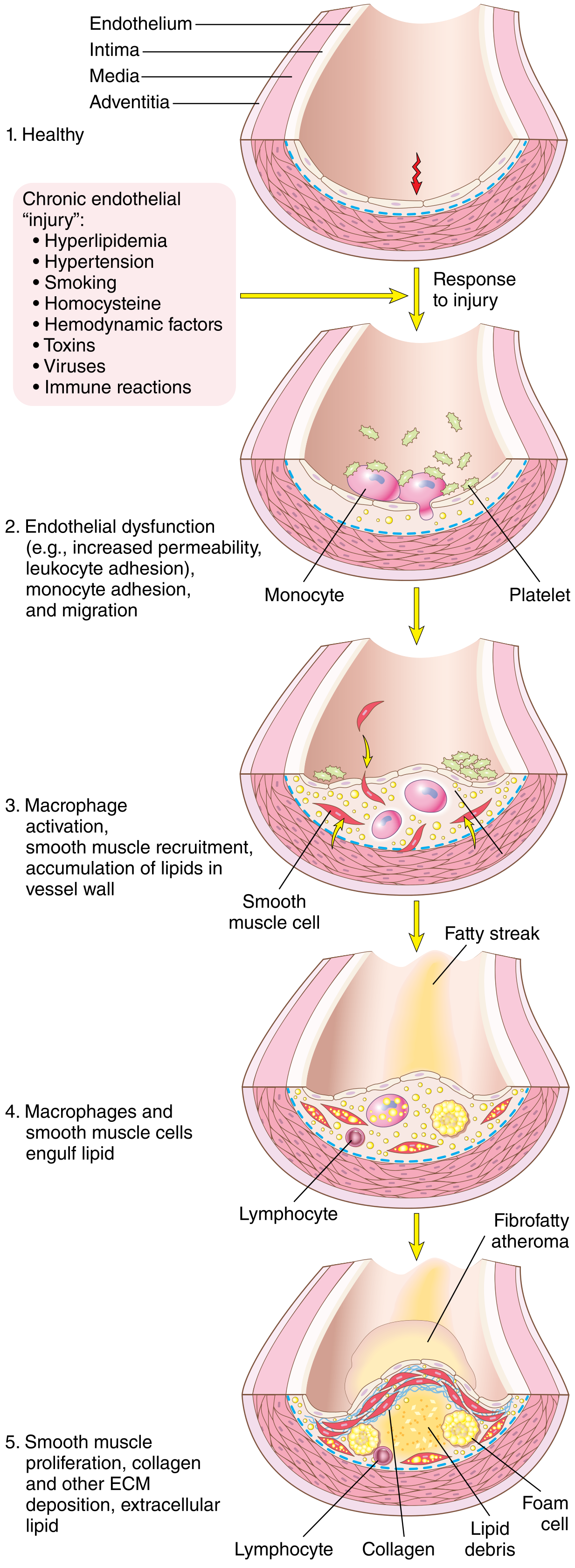 Evolution of arterial wall changes in the response to injury: from healthy vessel → endothelial dysfunction → monocyte adhesion → foam cell/fatty streak → fibrofatty atheroma with foam cells, lymphocytes, and collagen deposition