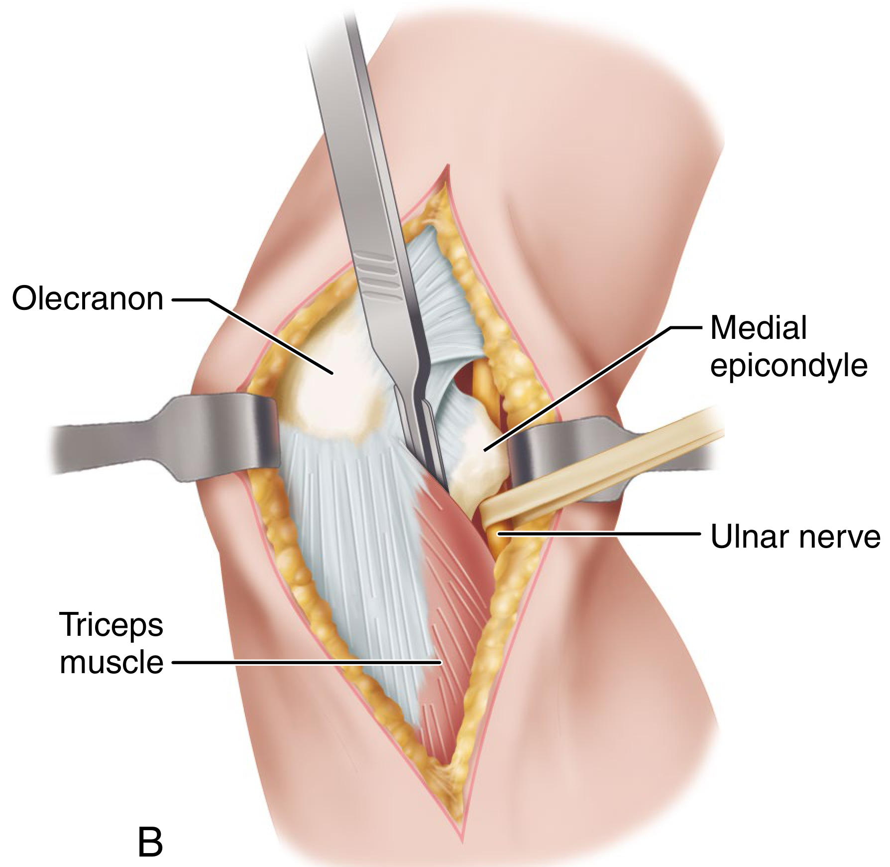 Bryan-Morrey approach Step B: elevation of triceps and ulnar nerve identification at medial epicondyle