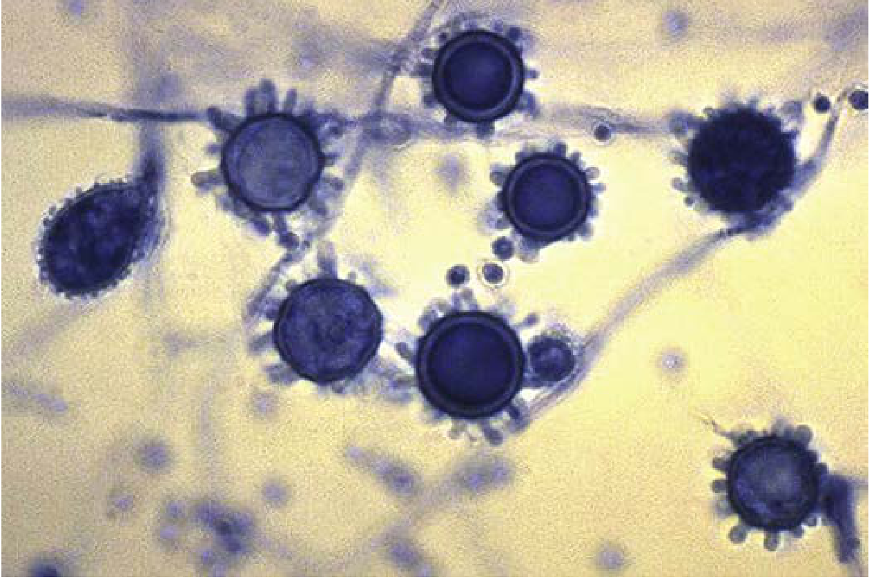Tuberculate macroconidia with microconidia of Histoplasma capsulatum in culture - characteristic environmental mold form (Lactophenol cotton blue stain, 400x)