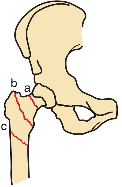 Fractures of the proximal femur: Neck (a), intertrochanteric (b), subtrochanteric (c)