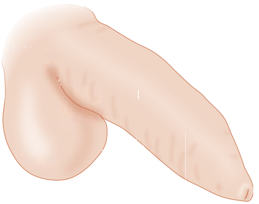 Medical illustration showing phimosis - the tight contracted foreskin preventing full retraction over the glans