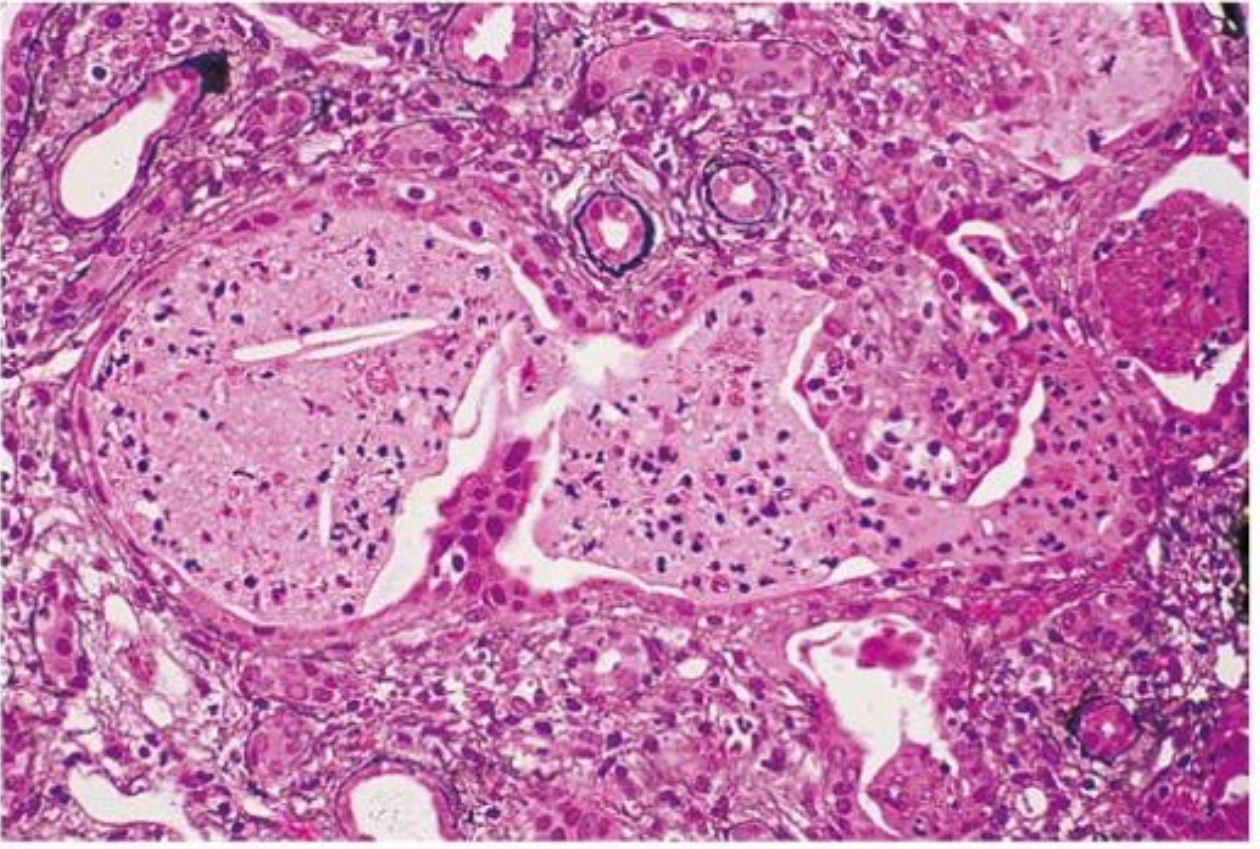 Acute pyelonephritis histology: dilated tubules filled with neutrophils (pus casts), interstitial inflammation