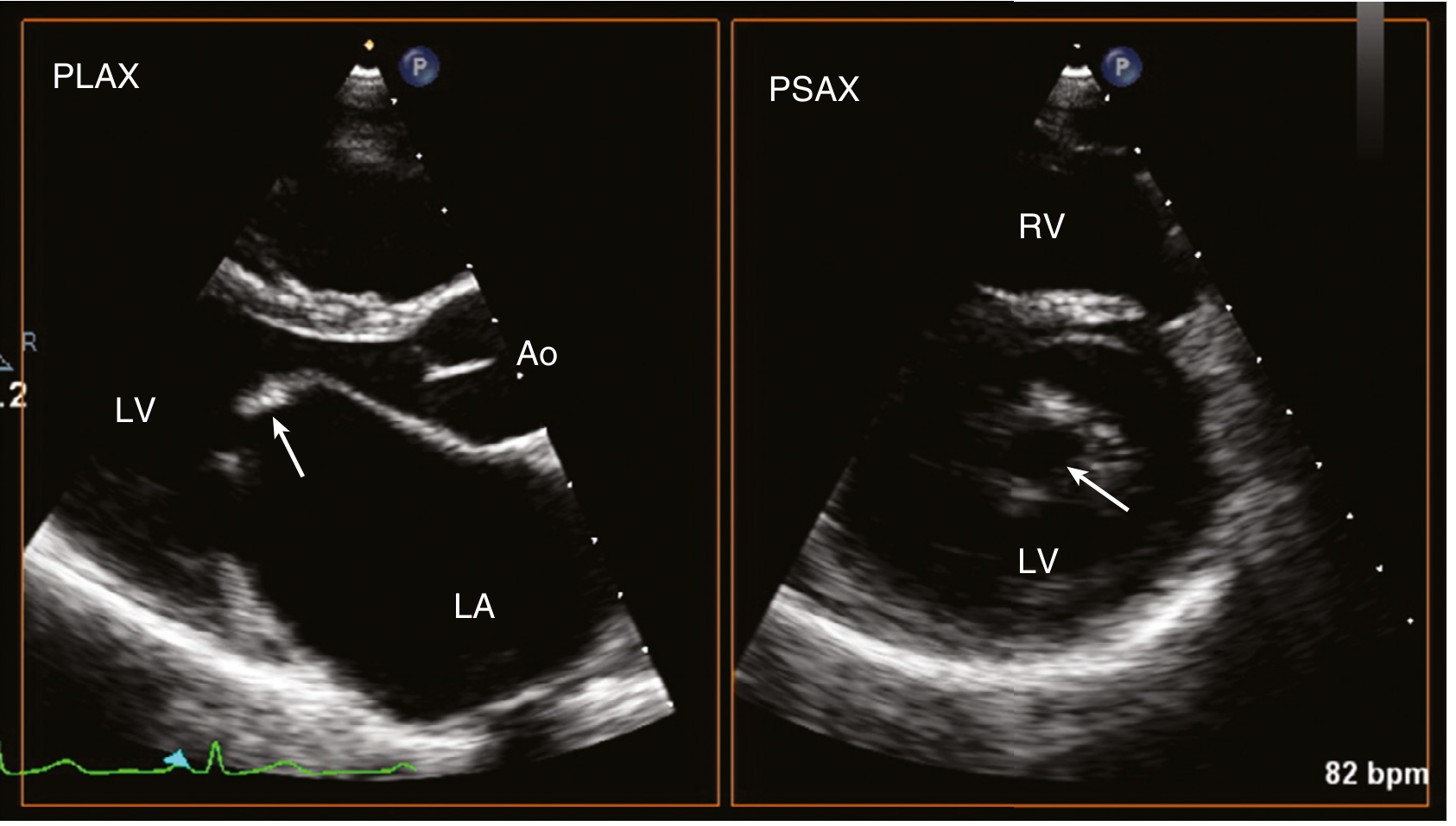 Real 2D echo in rheumatic MS: PLAX (left) showing "doming" of anterior mitral leaflet; PSAX (right) showing commissural fusion and small mitral orifice