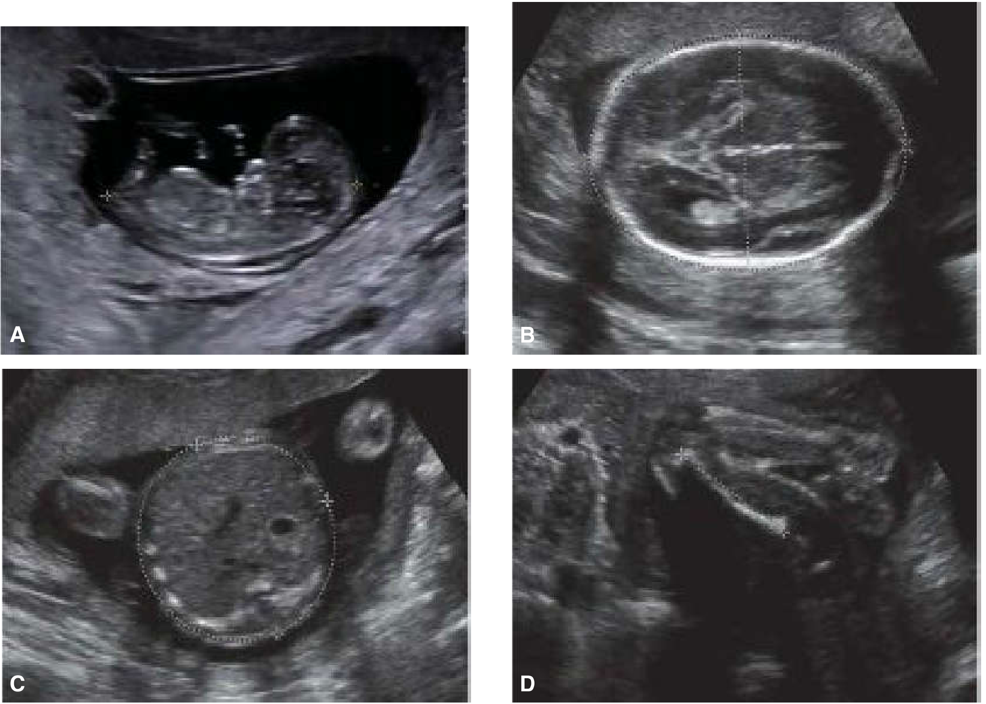 USG measurements: A. CRL in 10-week fetus; B. BPD/HC at 20 weeks; C. AC at 20 weeks; D. Femur length at 20 weeks