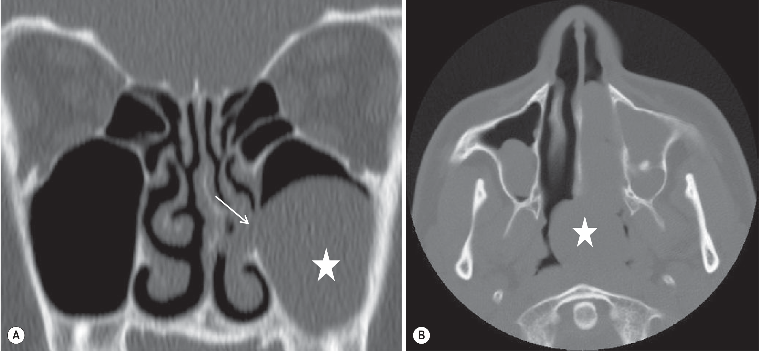 Antrochoanal polyp axial CT