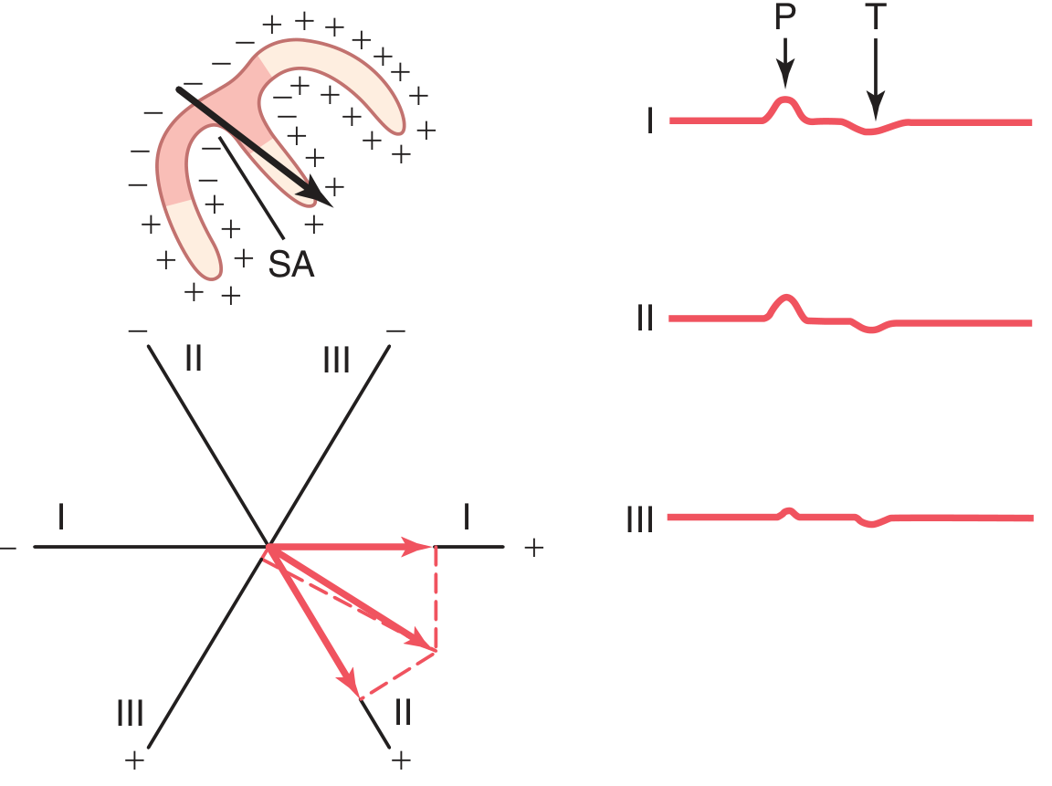 Atrial depolarization generating the P wave - the SA node initiates depolarization that spreads across both atria, producing upright P waves in leads I, II, and III