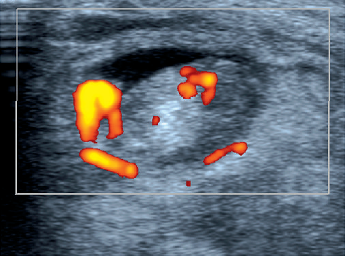 Tibialis Posterior Tenosynovitis on Doppler Ultrasound