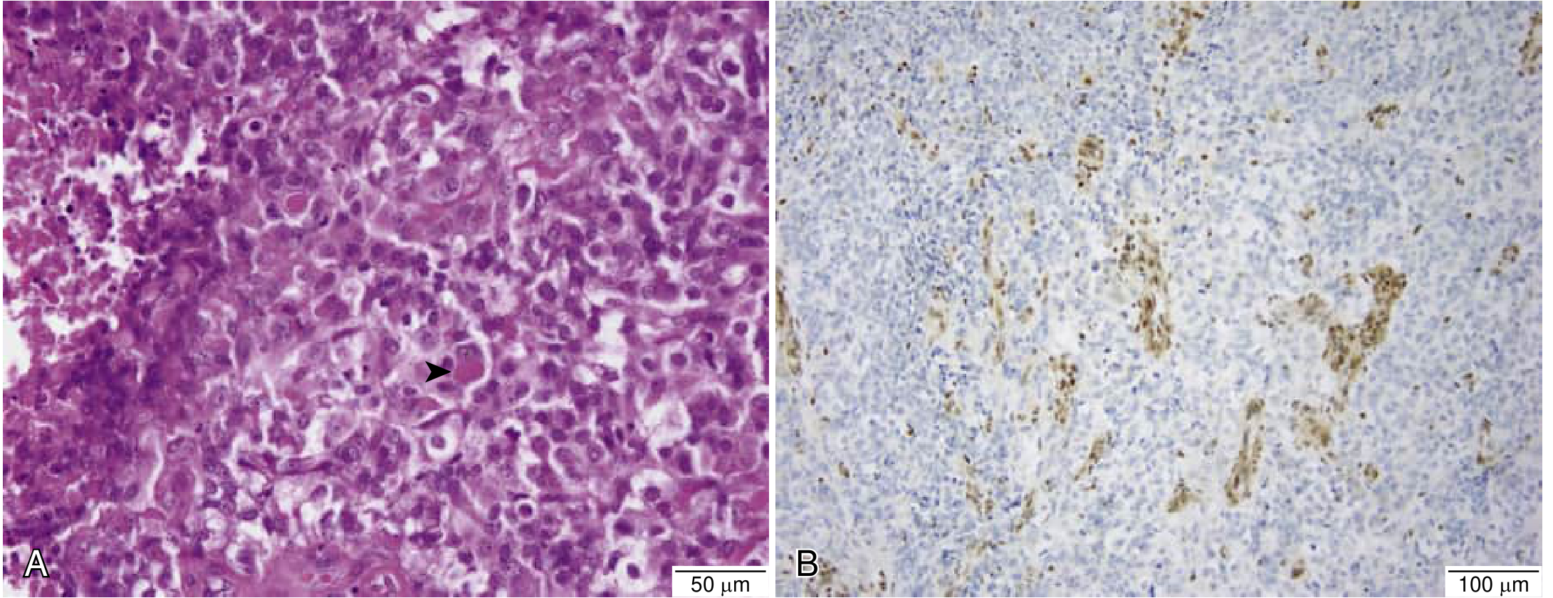 AT/RT histology (H&E left) and INI1 IHC showing nuclear loss in tumor cells with retention in vasculature (right) - Bradley and Daroff's Neurology