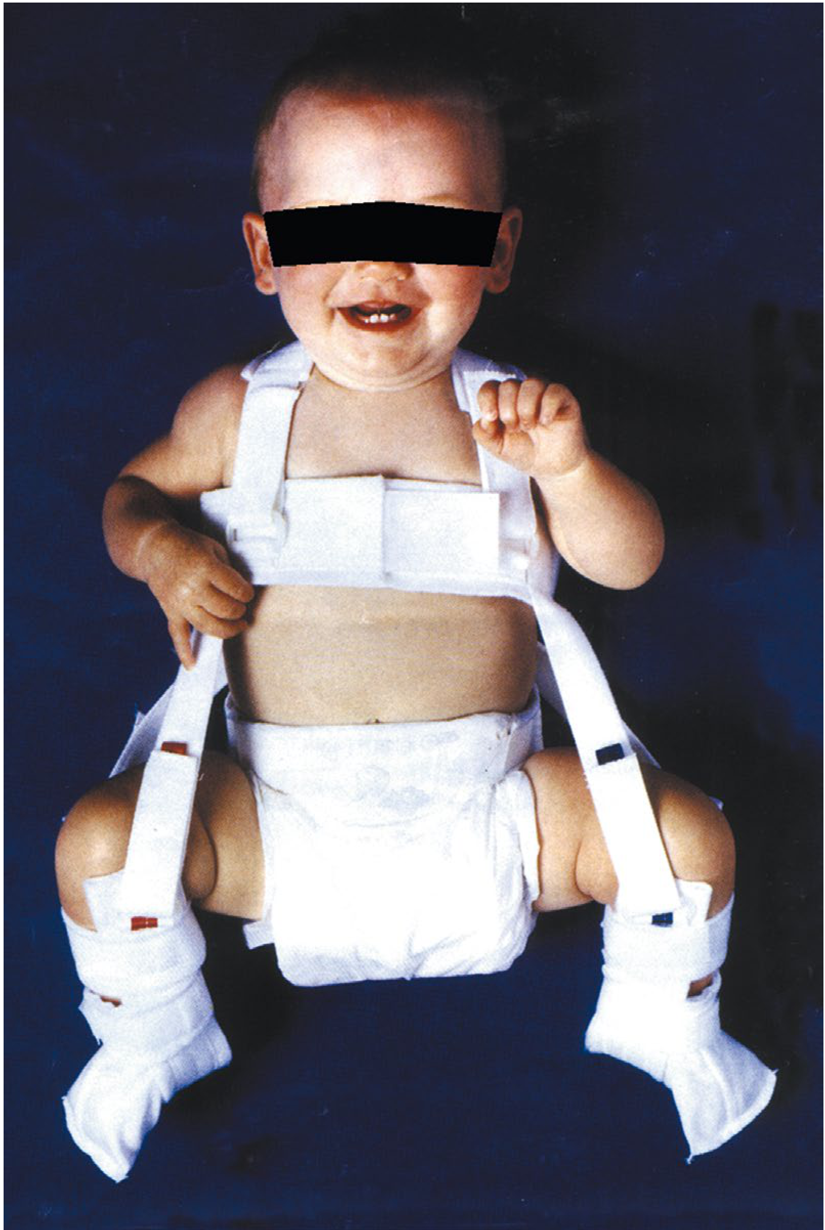 Properly applied Pavlik harness